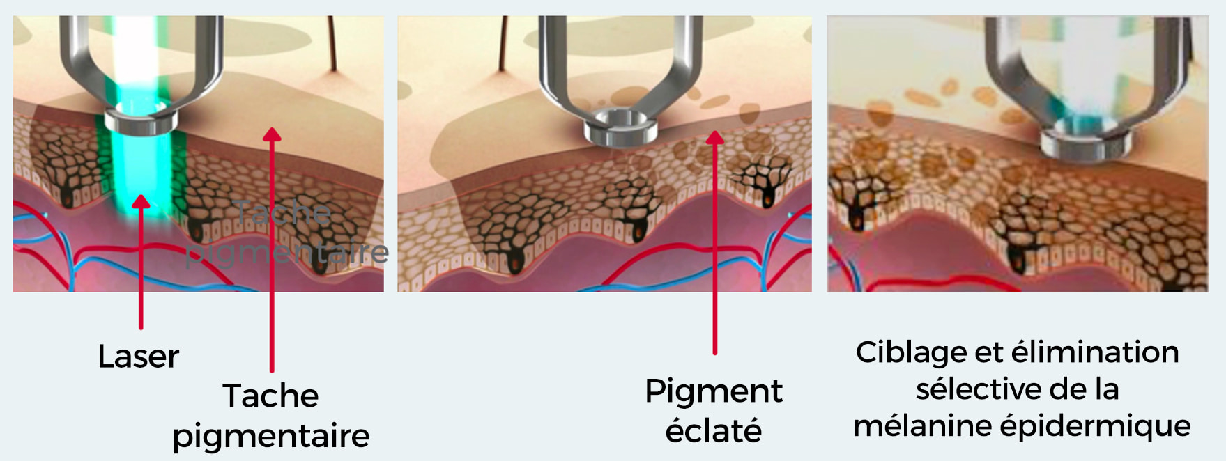 Laser Pigmentaire La R Union Traitement Des Varicosit S Dr Fray