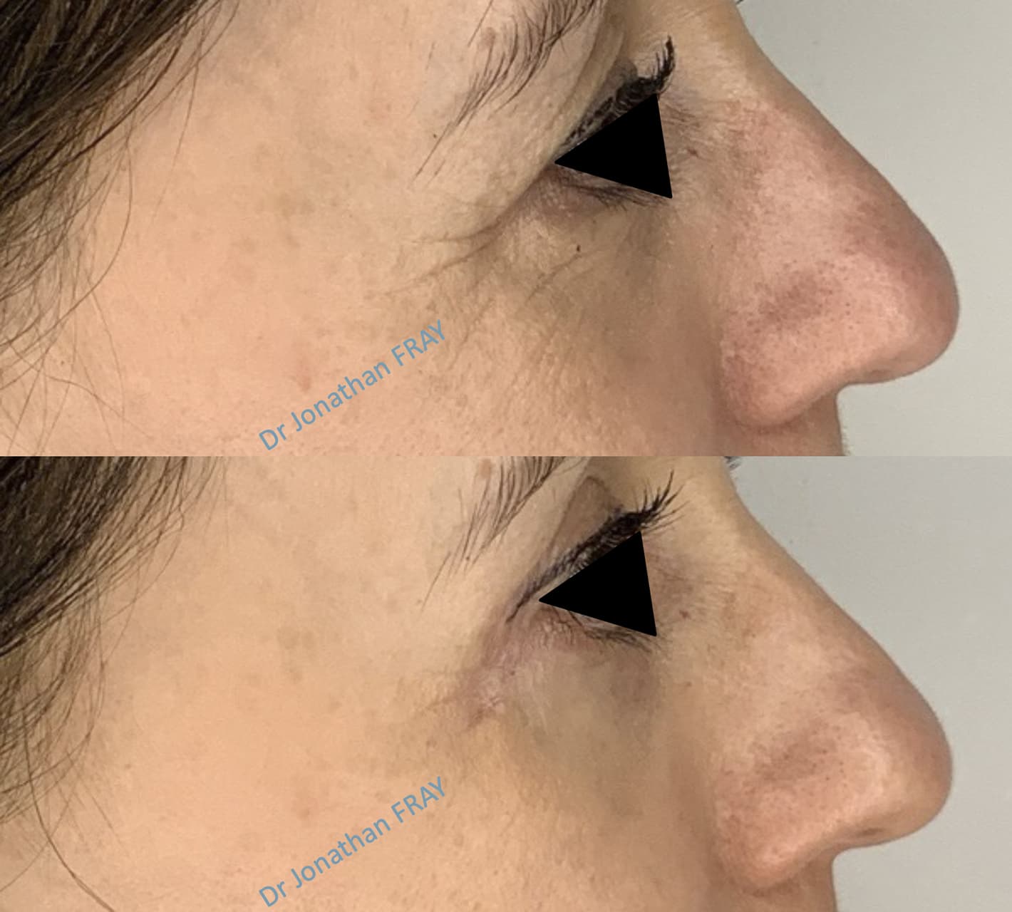 blepharoplastie-inferieure-2-avant-apres-1