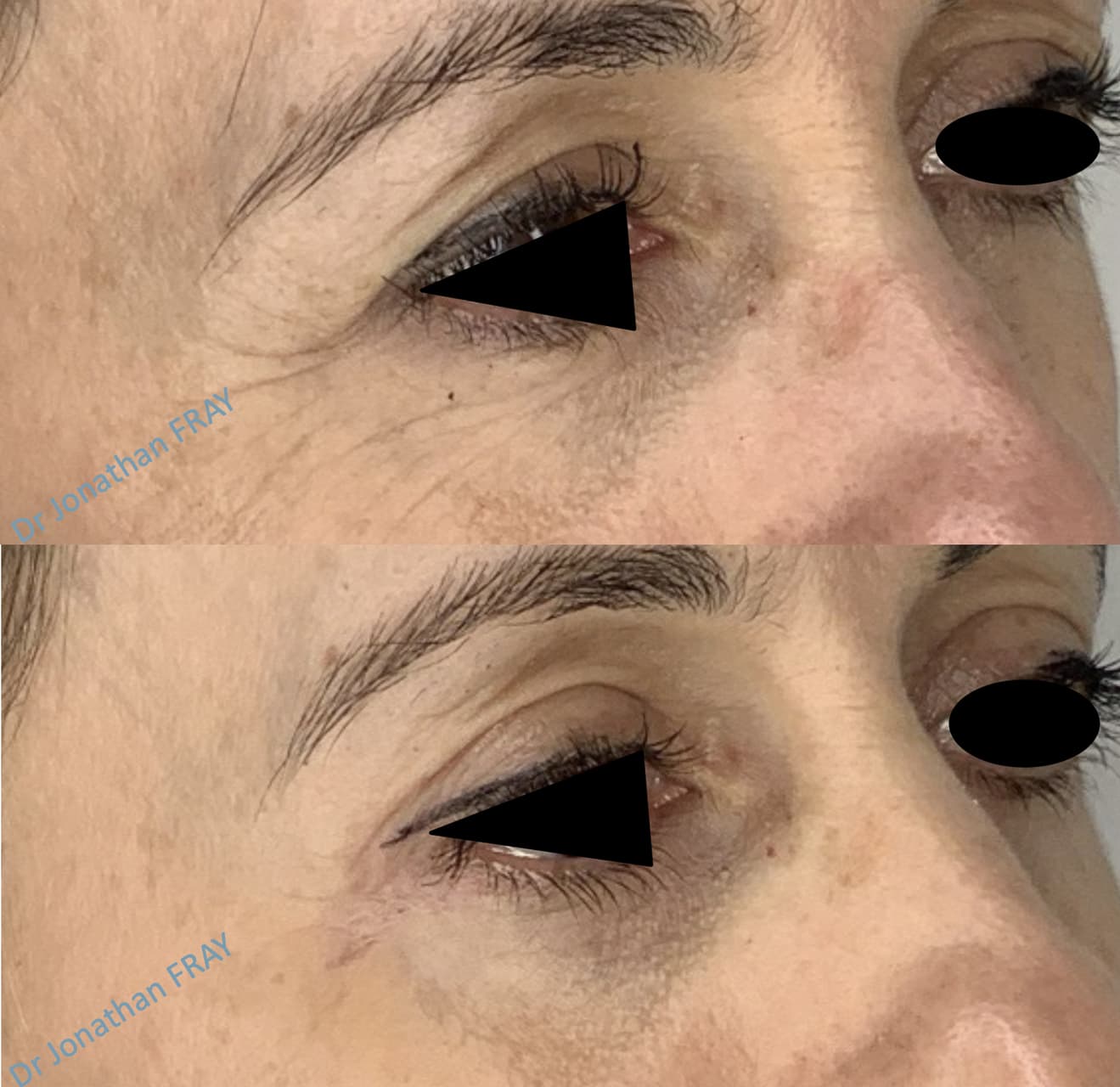 blepharoplastie-inferieure-2-avant-apres-2