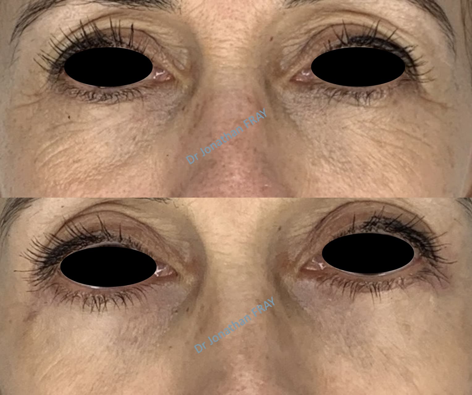 blepharoplastie-inferieure-2-avant-apres-3