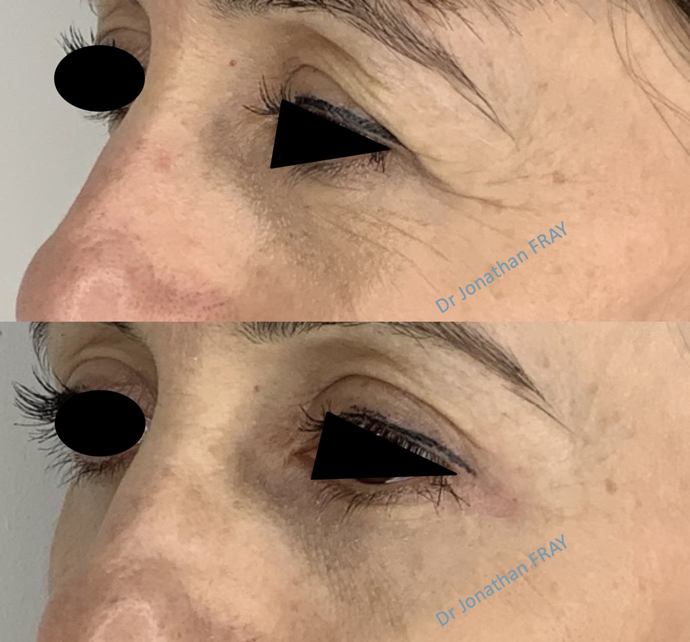 blepharoplastie-inferieure-2-avant-apres-4