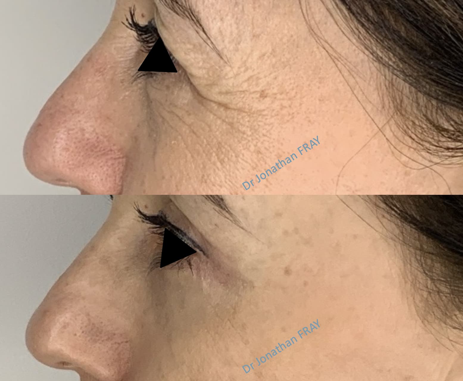 blepharoplastie-inferieure-2-avant-apres-5