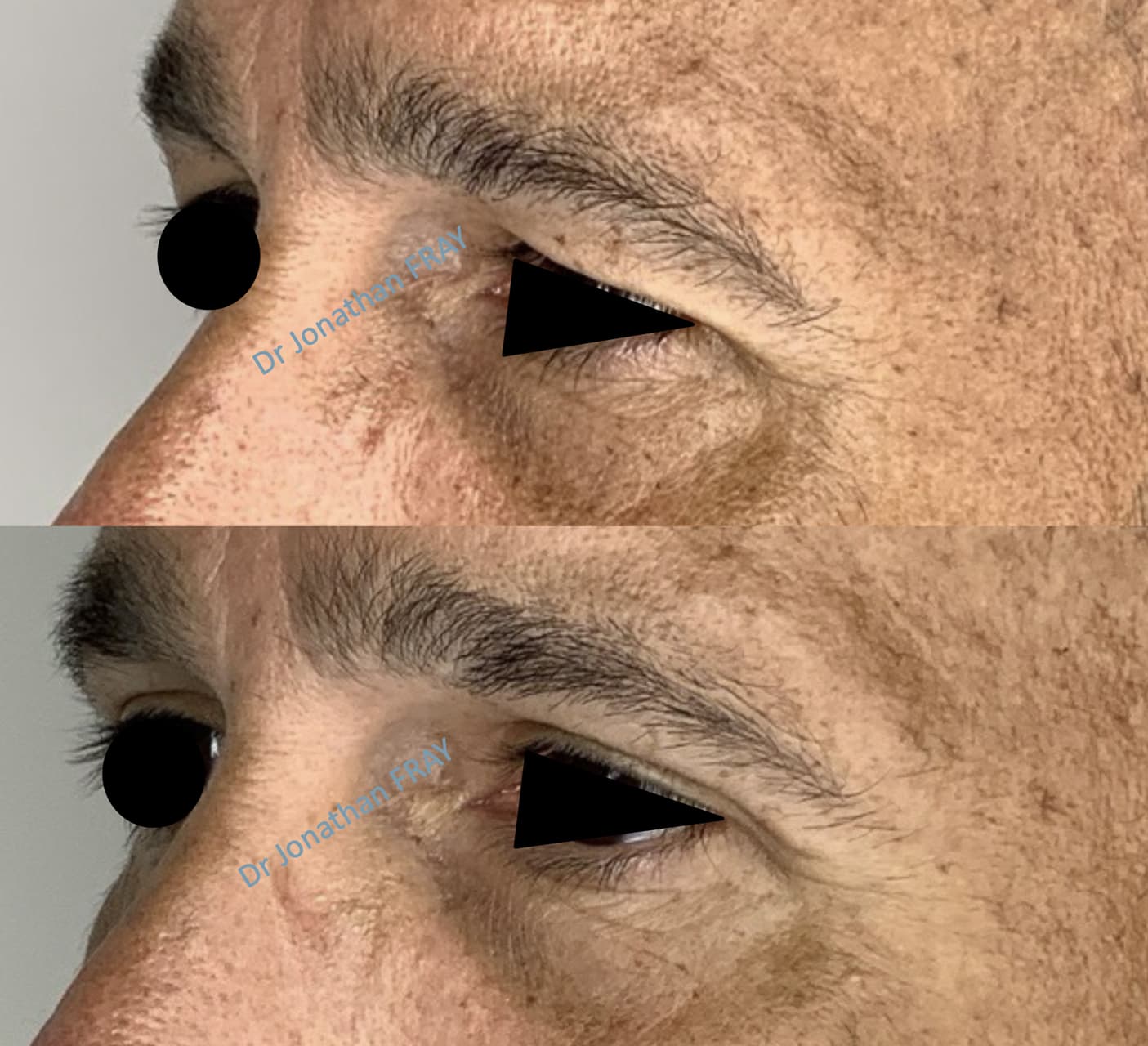 blepharoplastie-superieure-8-avant-apres-1