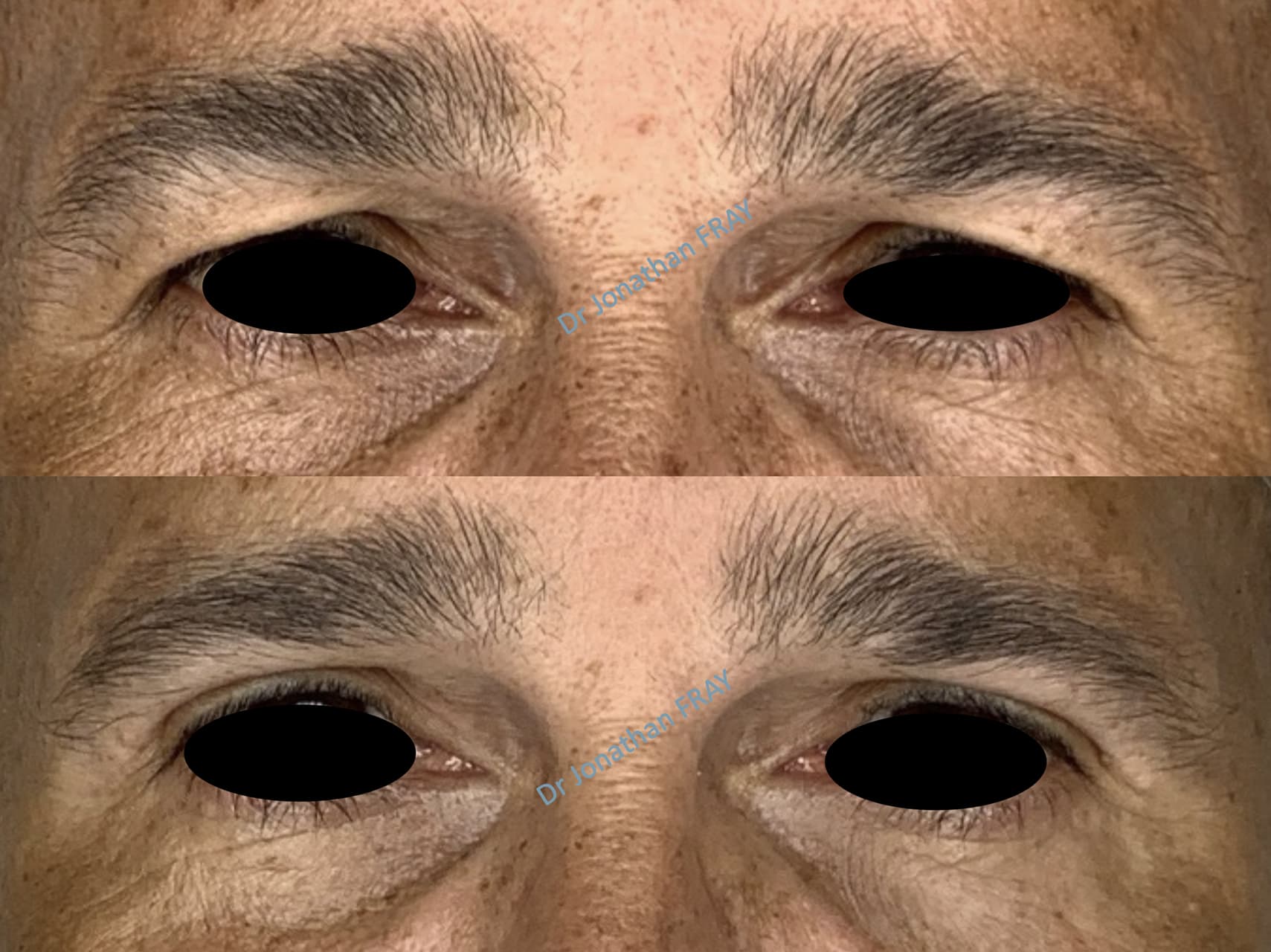 blepharoplastie-superieure-8-avant-apres-2
