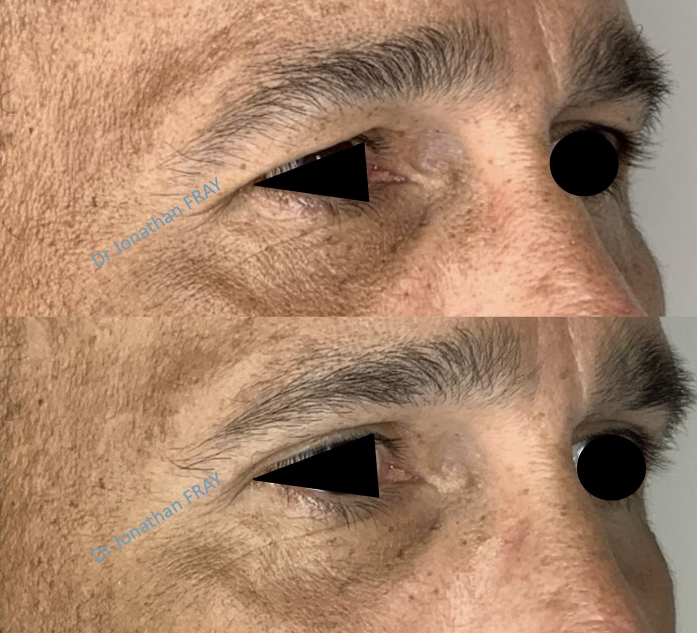 blepharoplastie-superieure-8-avant-apres-3