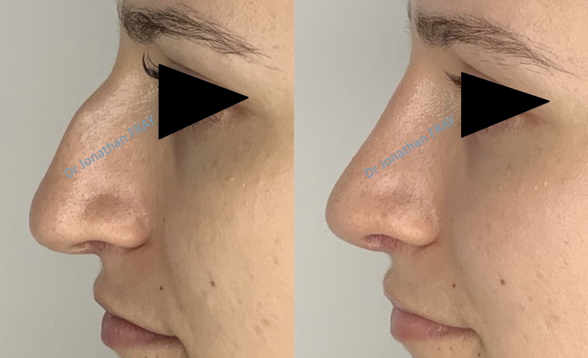 rhinoplastie-8-avant-apres-1