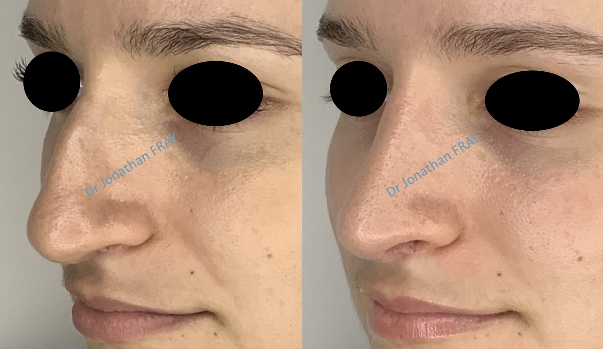 rhinoplastie-8-avant-apres-2