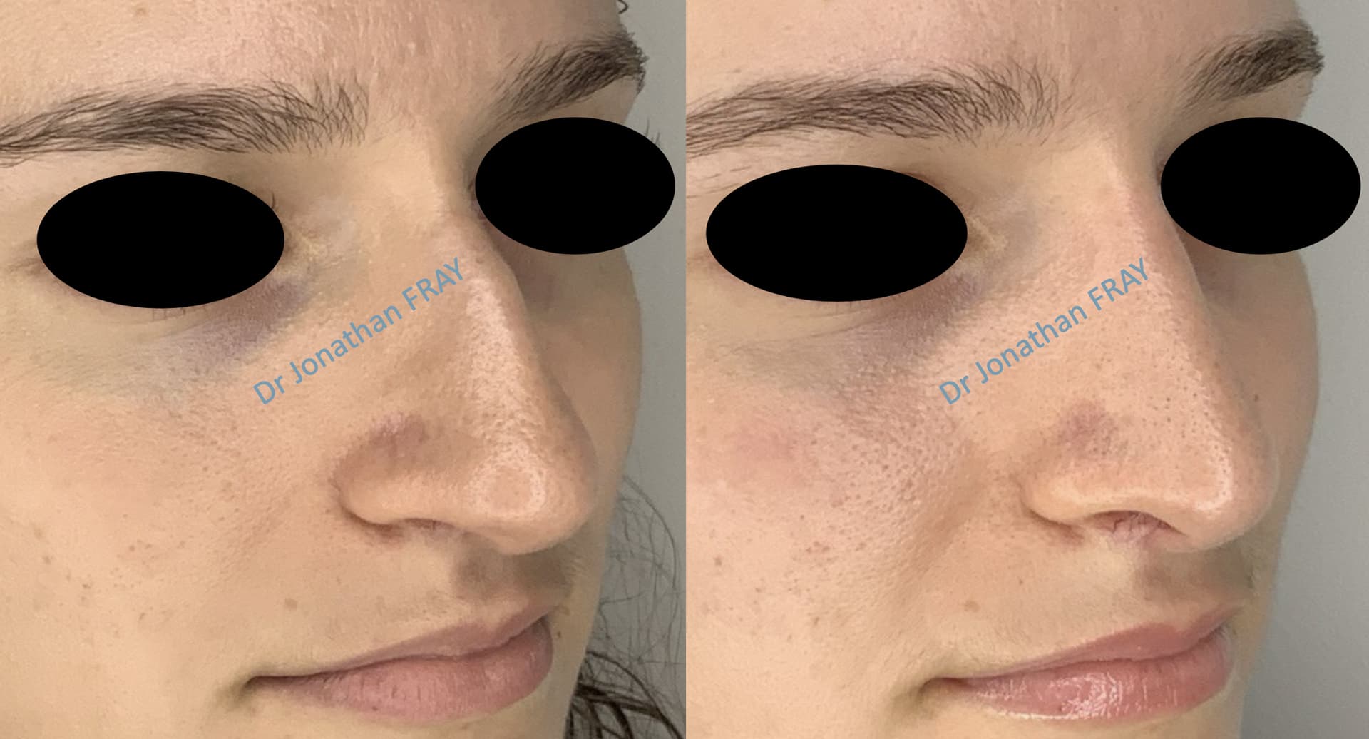 rhinoplastie-8-avant-apres-3