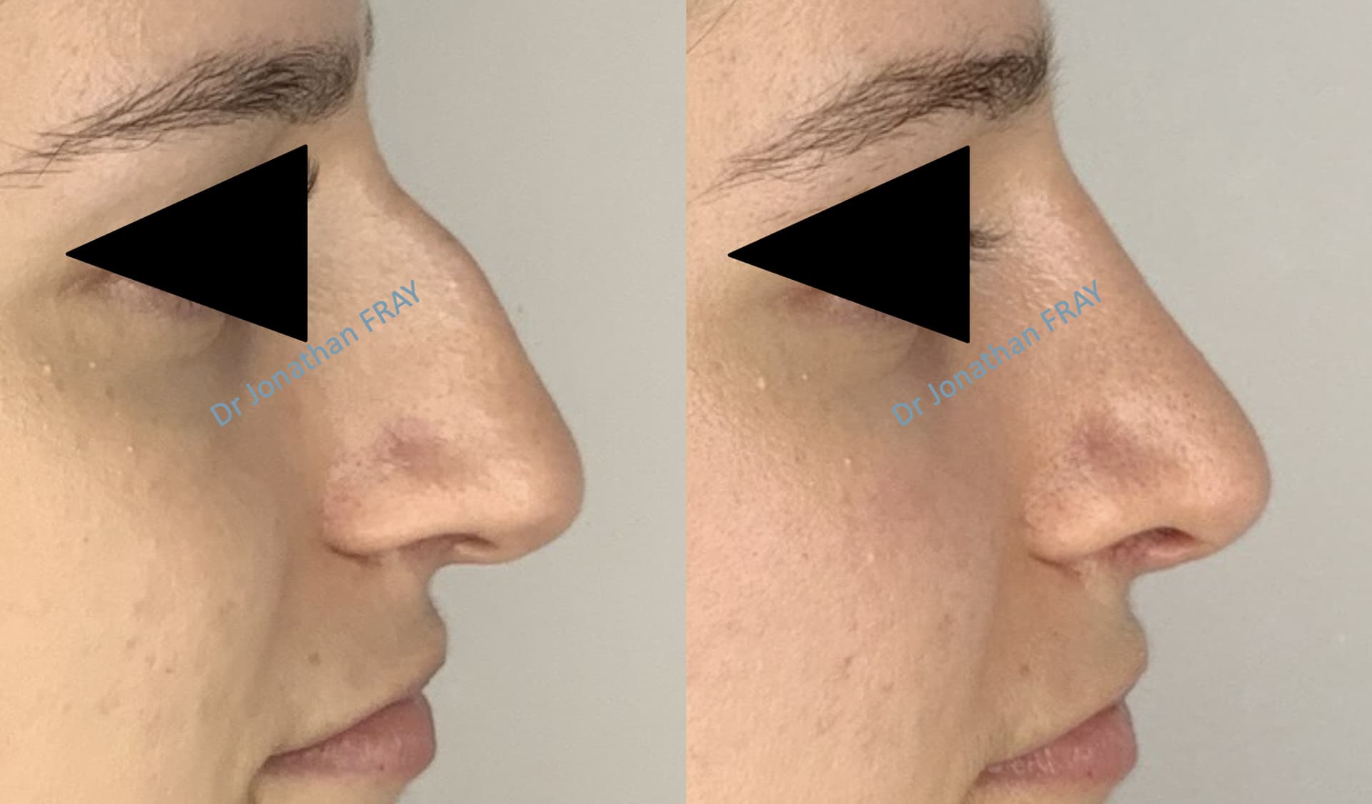 rhinoplastie-8-avant-apres-4