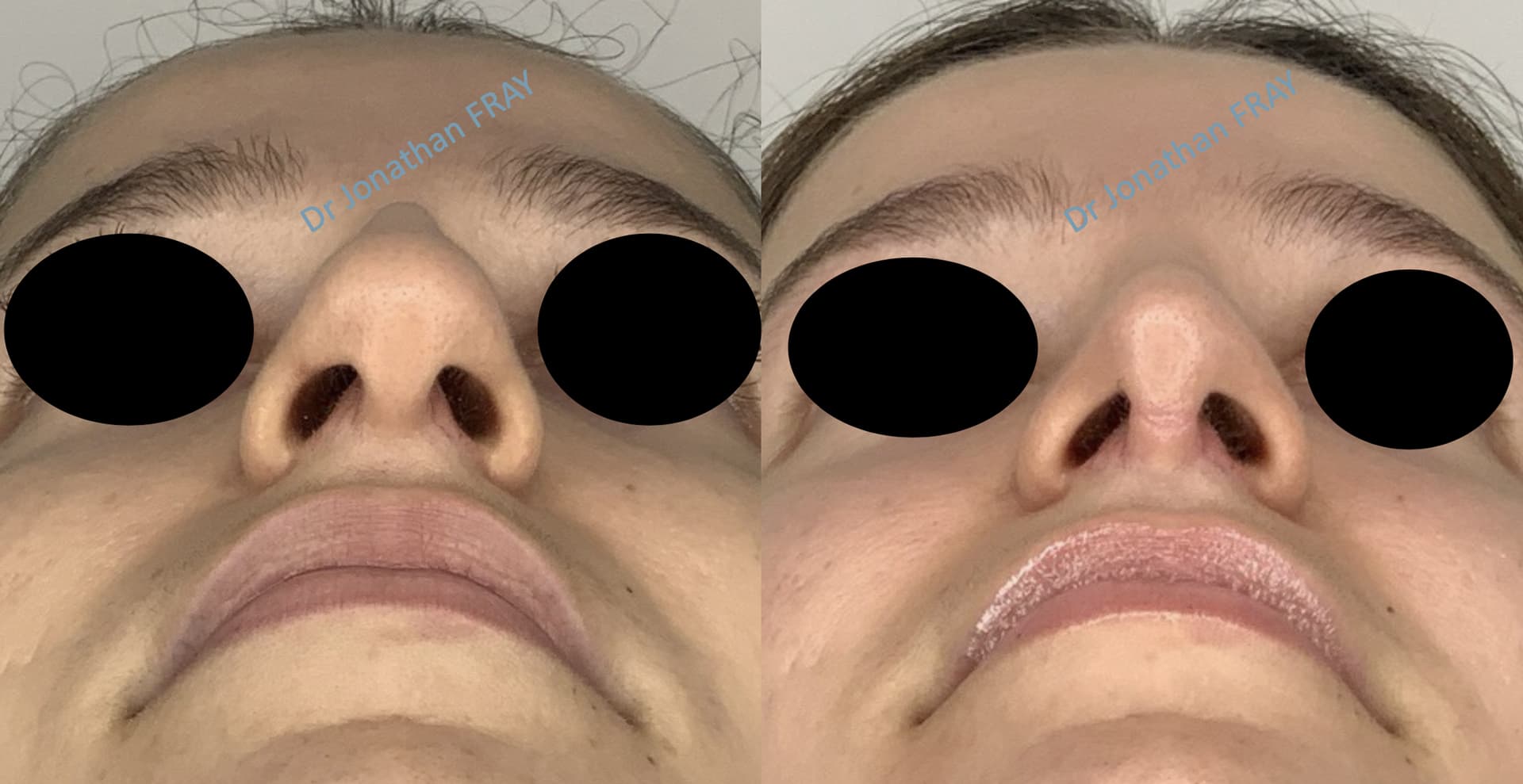 rhinoplastie-8-avant-apres-5