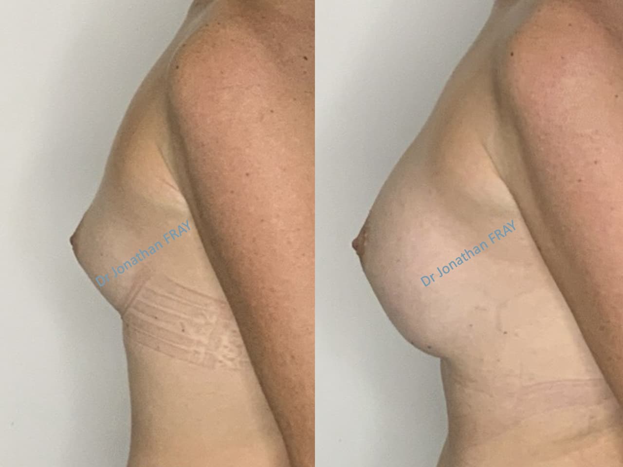 protheses-mammaires-35-avant-apres-1 Exemple de résultat de pose d'implants mammaires par le Dr Fray à La Réunion - Vue 1
