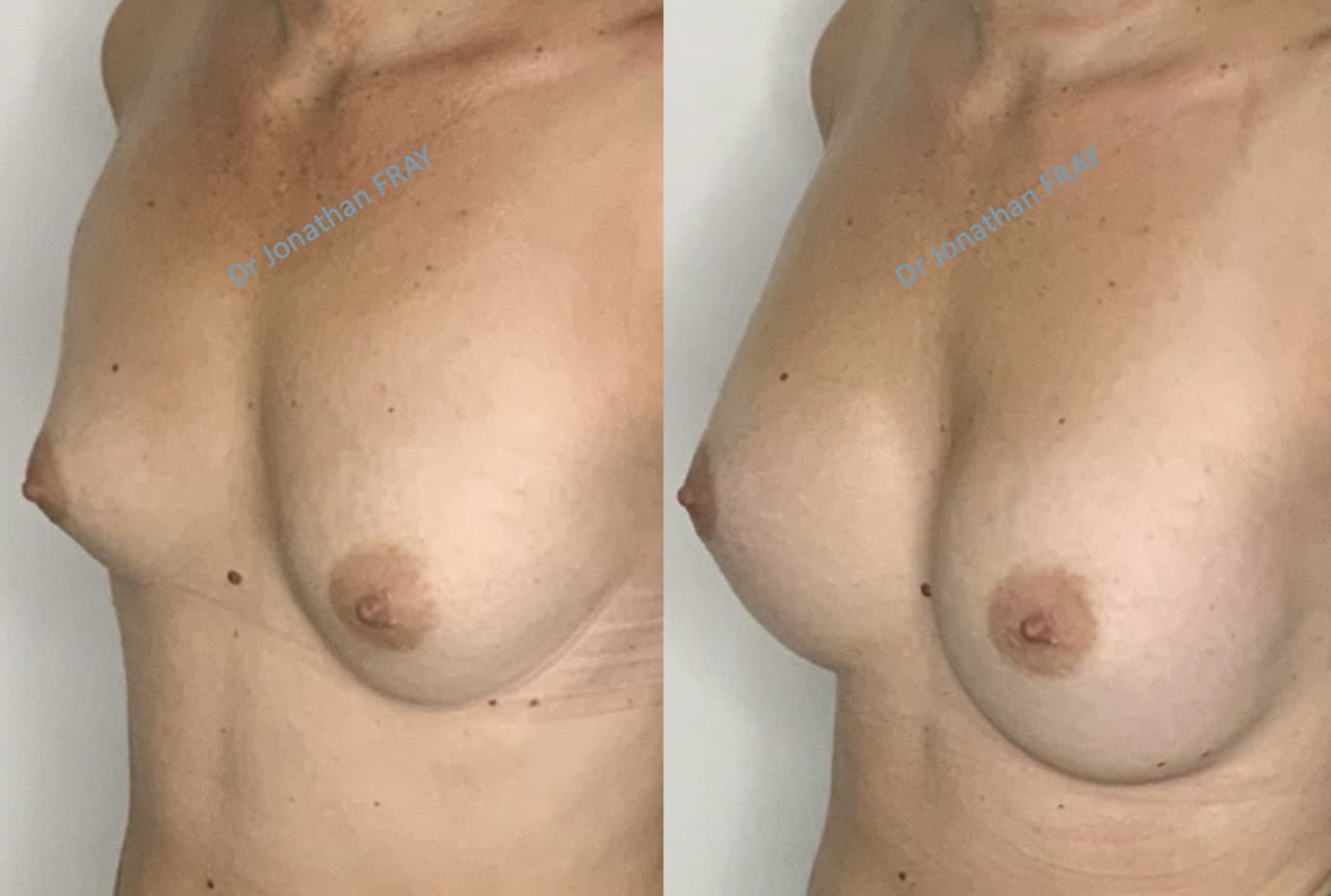 protheses-mammaires-35-avant-apres-2 Exemple de résultat de pose d'implants mammaires par le Dr Fray à La Réunion - Vue 2