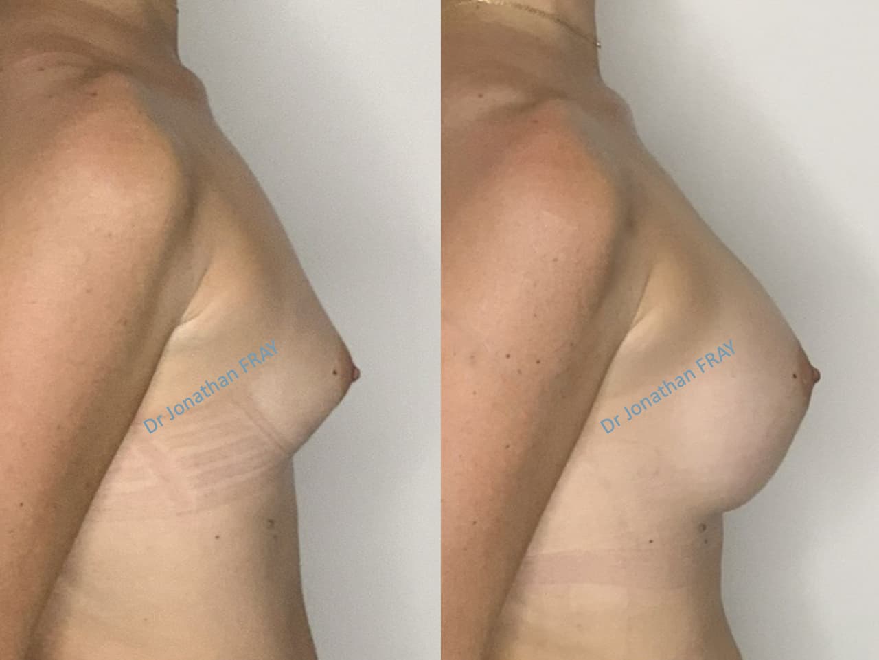 protheses-mammaires-35-avant-apres-6 Exemple de résultat de pose d'implants mammaires par le Dr Fray à La Réunion - Vue 6