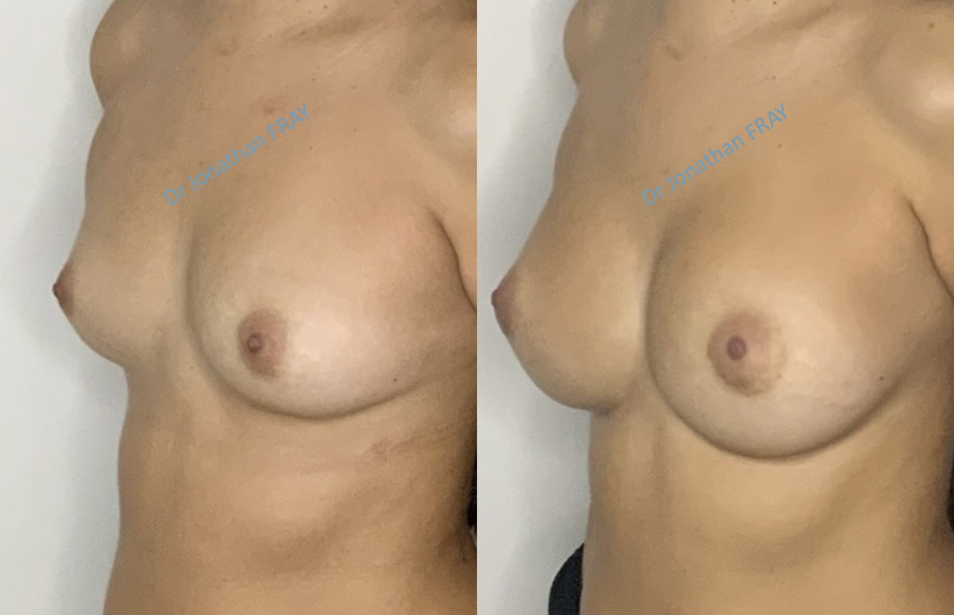 protheses-mammaires-36-avant-apres-2 Photos avant après d'une augmentation mammaire réalisée par le Dr Fray à La Réunion - Vue 2
