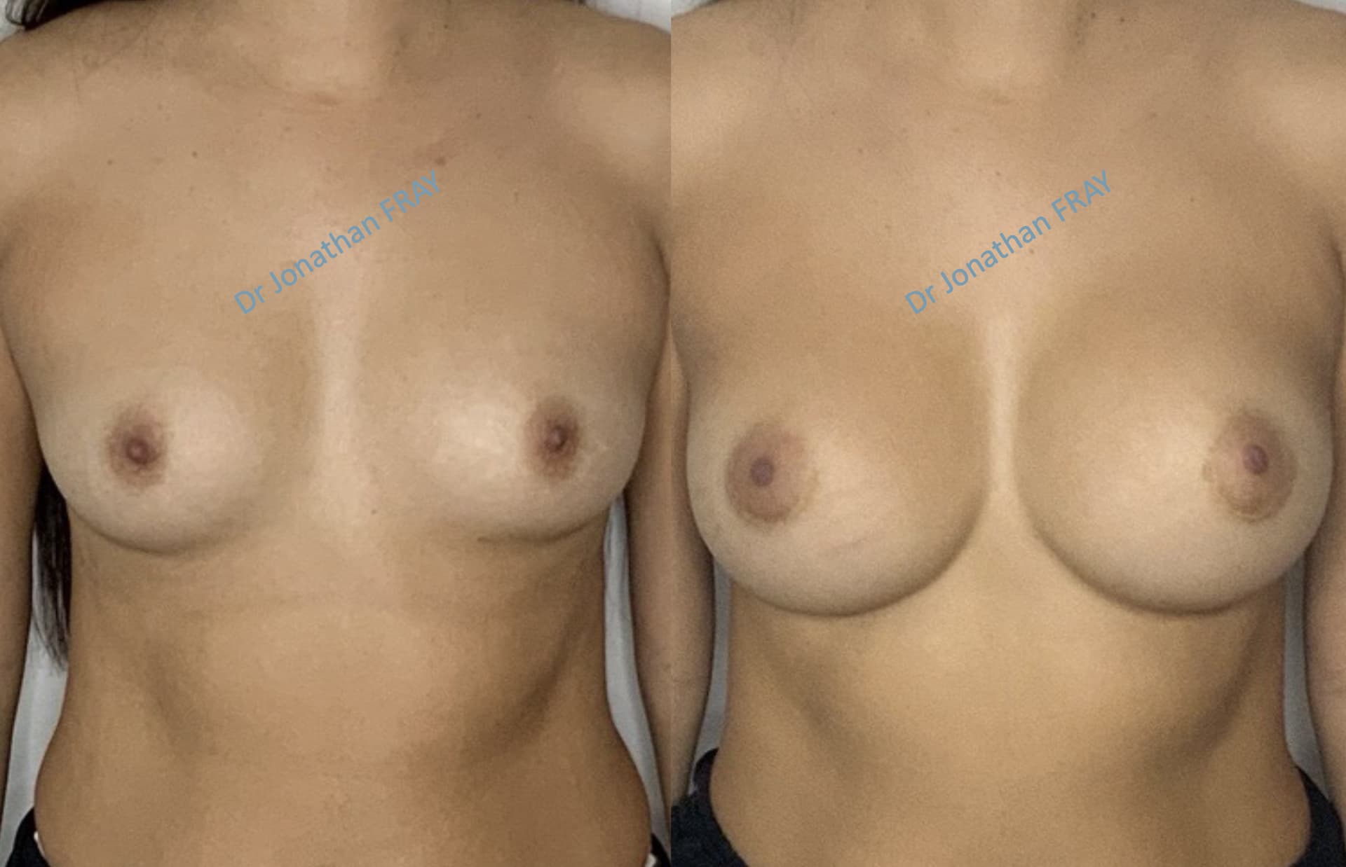 protheses-mammaires-36-avant-apres-3 Photos avant après d'une augmentation mammaire réalisée par le Dr Fray à La Réunion - Vue 3