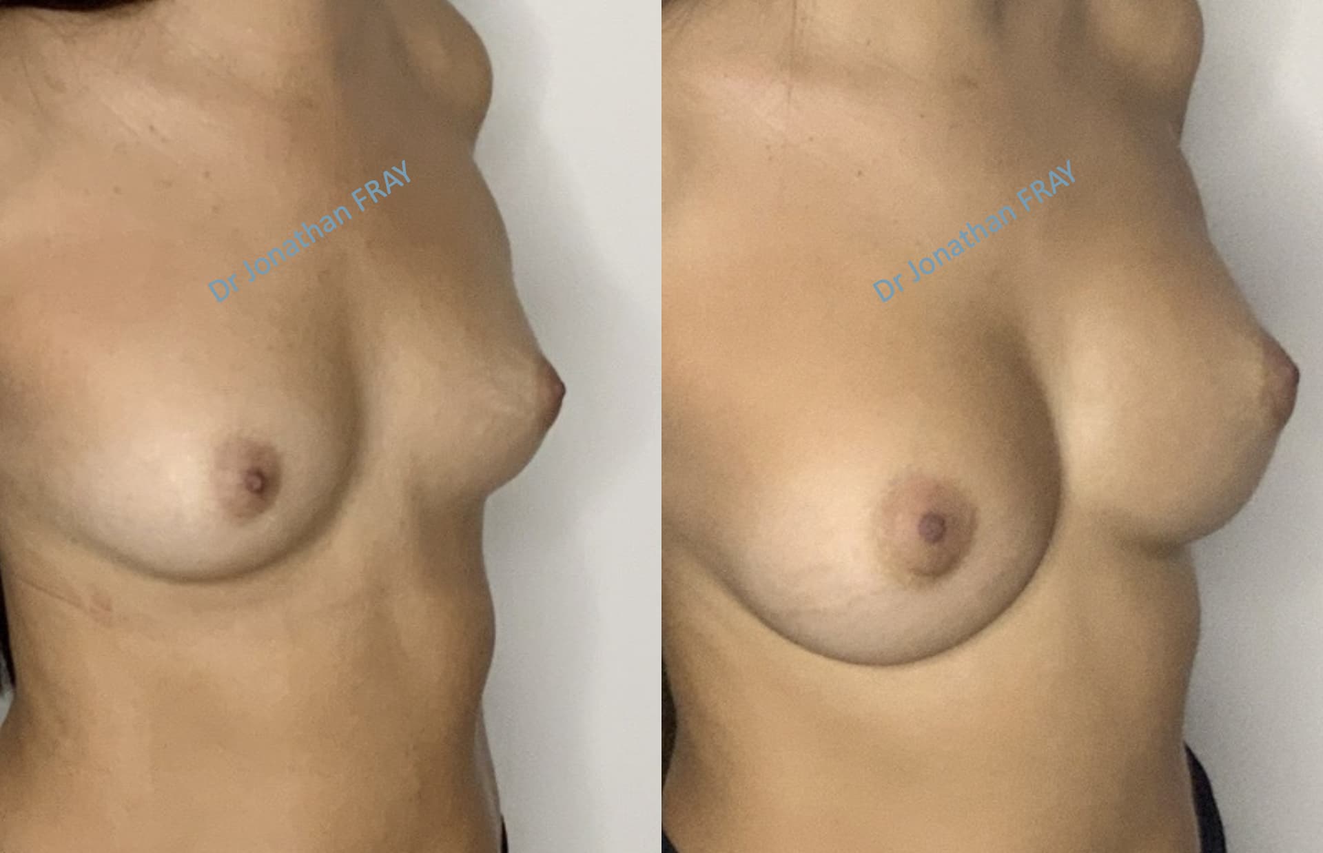 protheses-mammaires-36-avant-apres-5 Photos avant après d'une augmentation mammaire réalisée par le Dr Fray à La Réunion - Vue 5