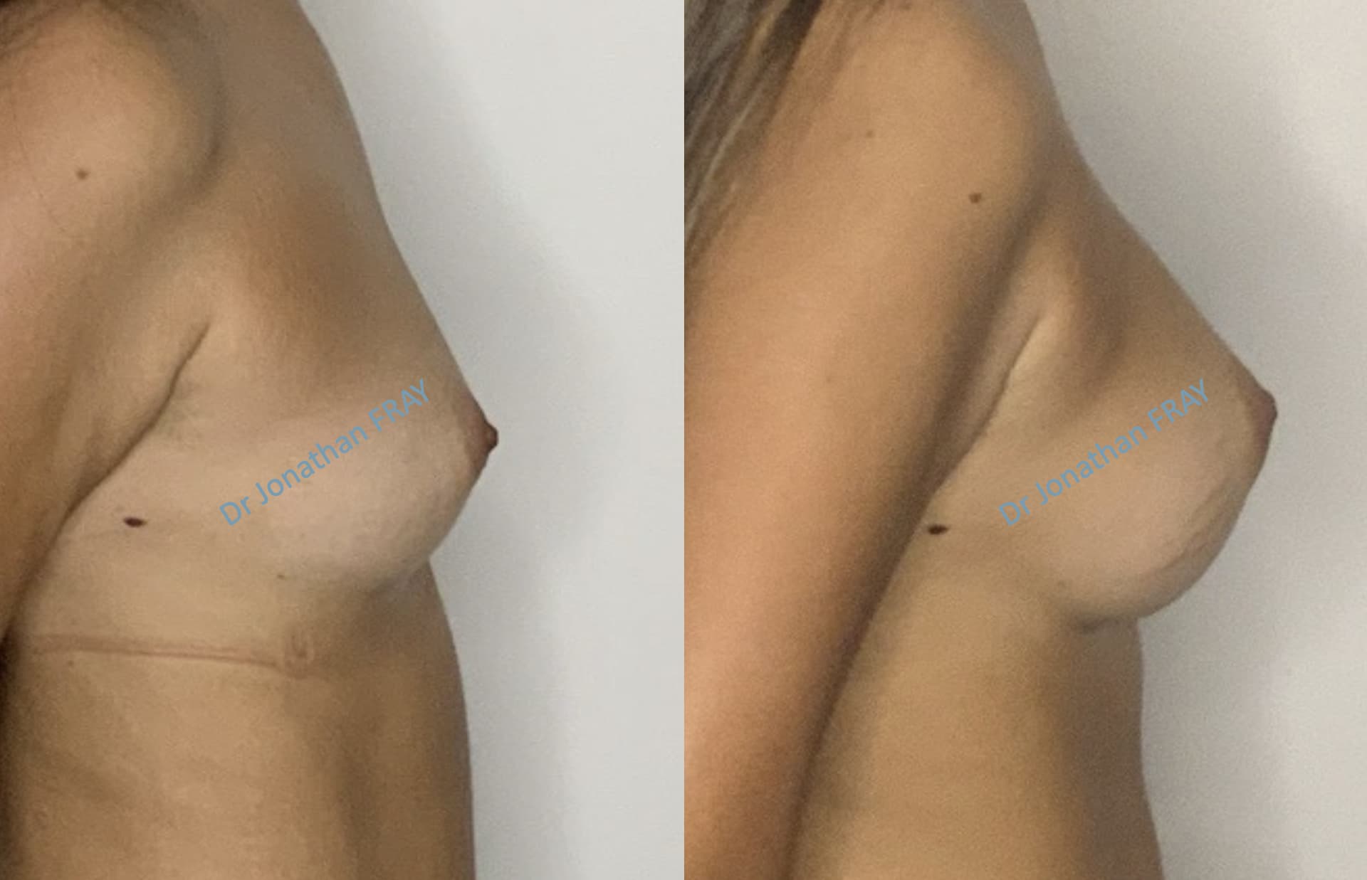 protheses-mammaires-36-avant-apres-6 Photos avant après d'une augmentation mammaire réalisée par le Dr Fray à La Réunion - Vue 6