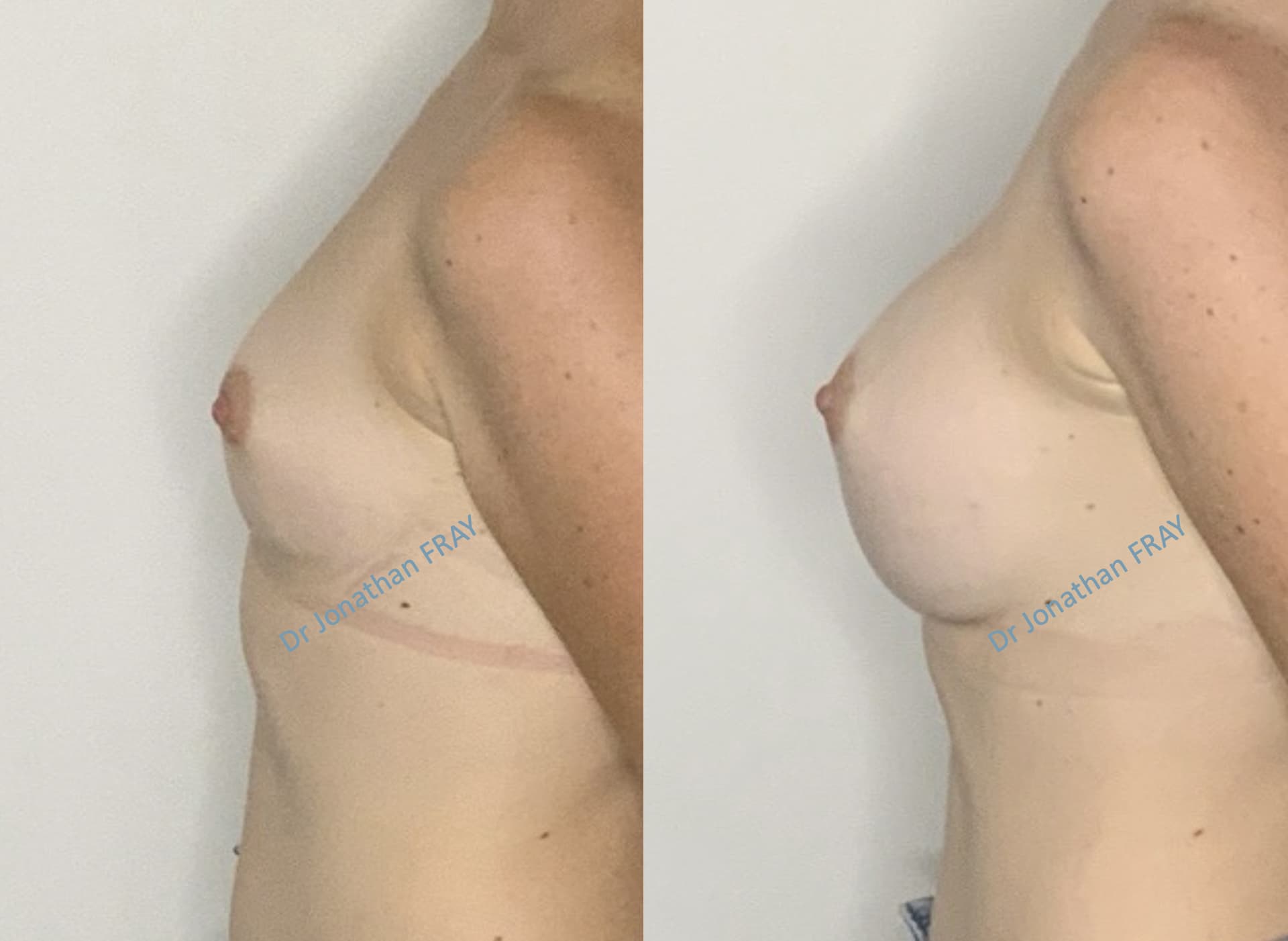 protheses-mammaires-37-avant-apres-1 Photos avant après d'une augmentation mammaire par implants réalisée par le Dr Fray à La Réunion - Vue 1