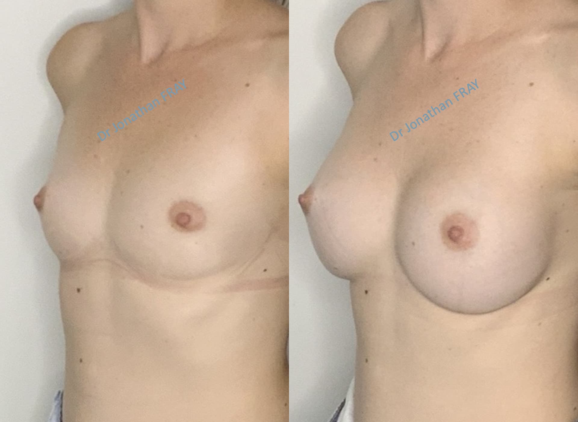 protheses-mammaires-37-avant-apres-2 Photos avant après d'une augmentation mammaire par implants réalisée par le Dr Fray à La Réunion - Vue 2