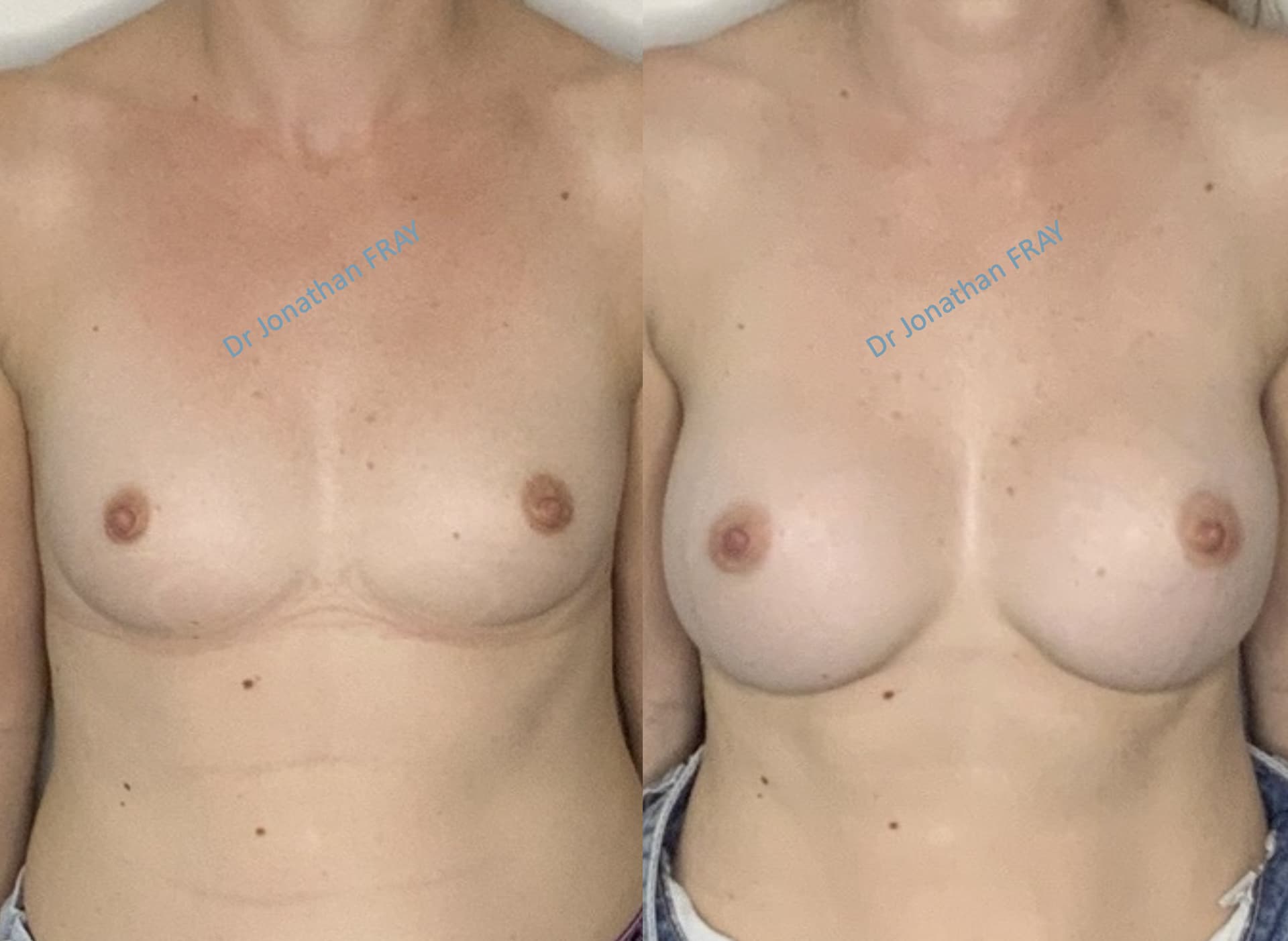 protheses-mammaires-37-avant-apres-3 Photos avant après d'une augmentation mammaire par implants réalisée par le Dr Fray à La Réunion - Vue 3