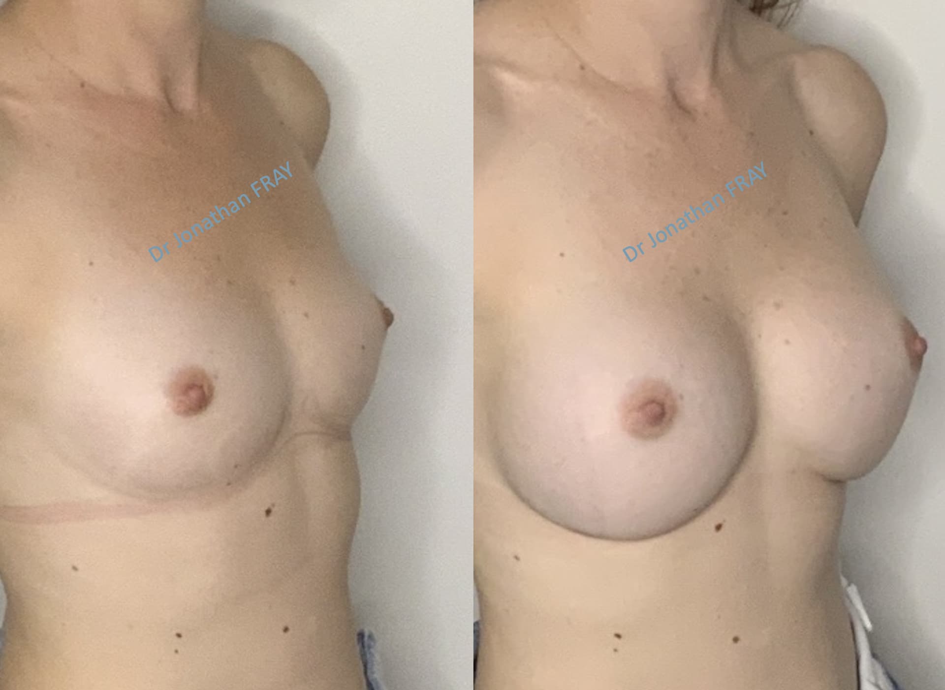 protheses-mammaires-37-avant-apres-5 Photos avant après d'une augmentation mammaire par implants réalisée par le Dr Fray à La Réunion - Vue 5