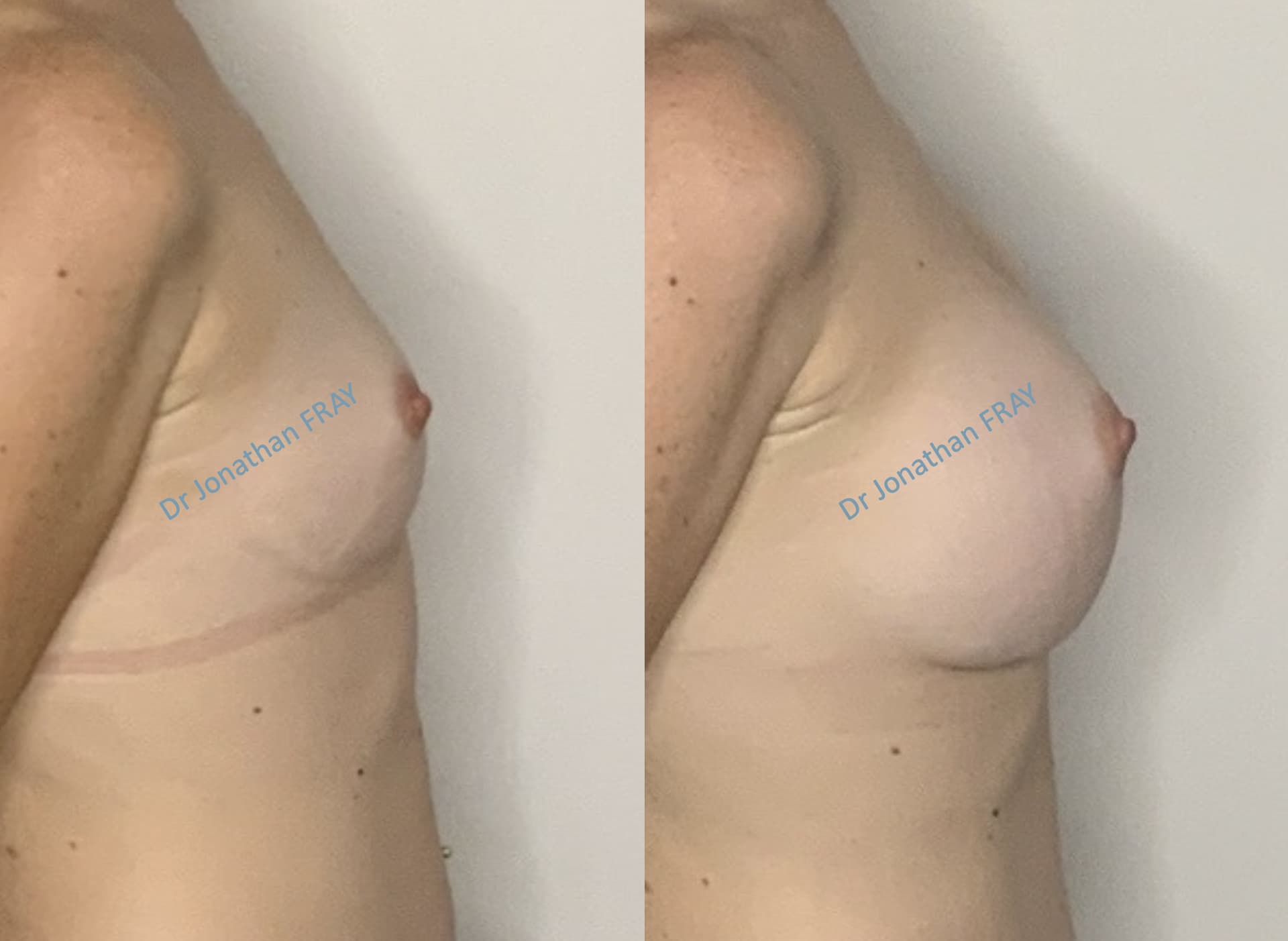 protheses-mammaires-37-avant-apres-6 Photos avant après d'une augmentation mammaire par implants réalisée par le Dr Fray à La Réunion - Vue 6