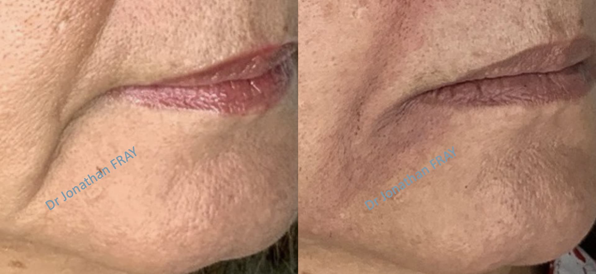 acide-hyaluronique-plis-amertume-2-avant-apres-1