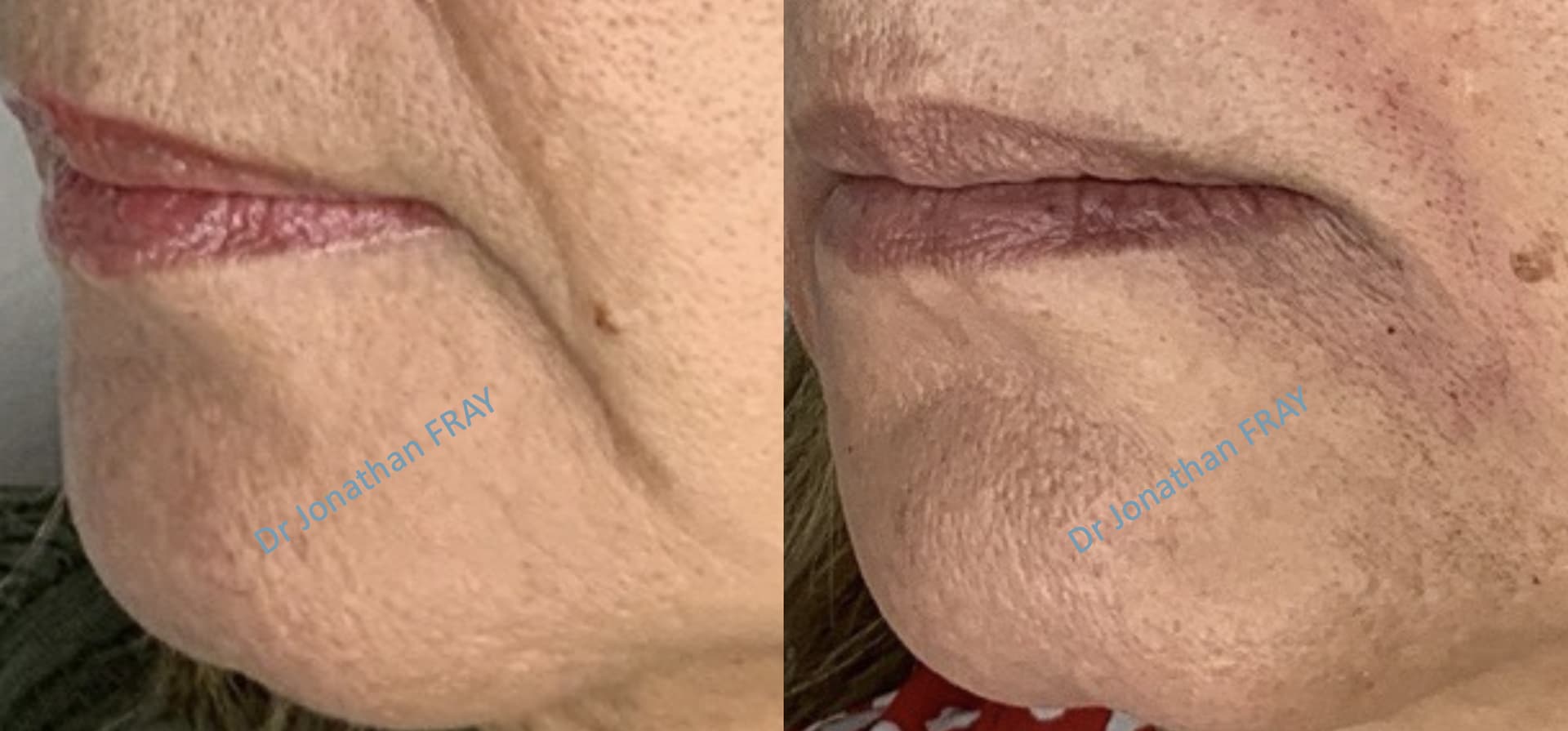 acide-hyaluronique-plis-amertume-2-avant-apres-2