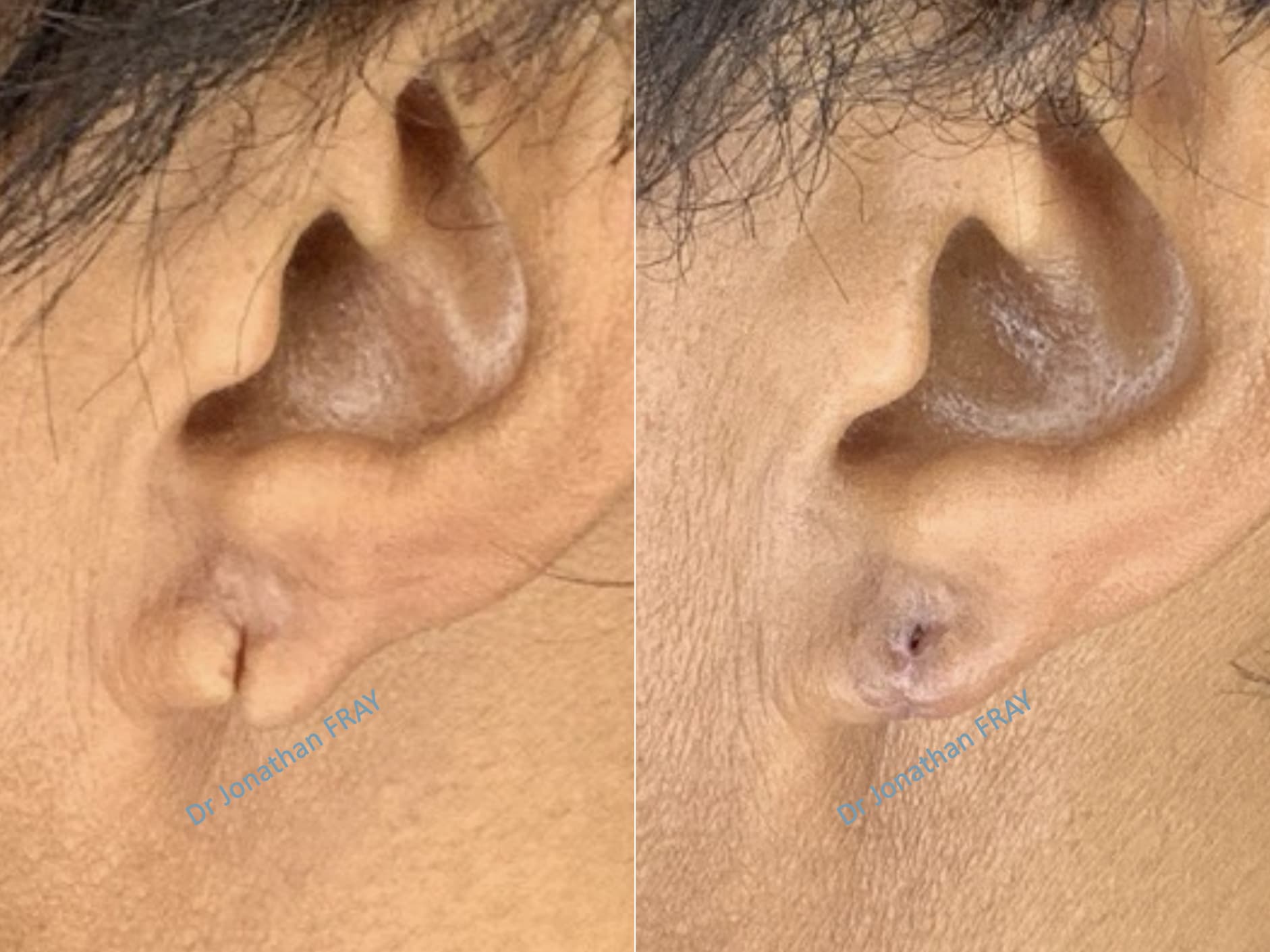chirurgie-lobe-oreille-fendu-1-avant-apres-2