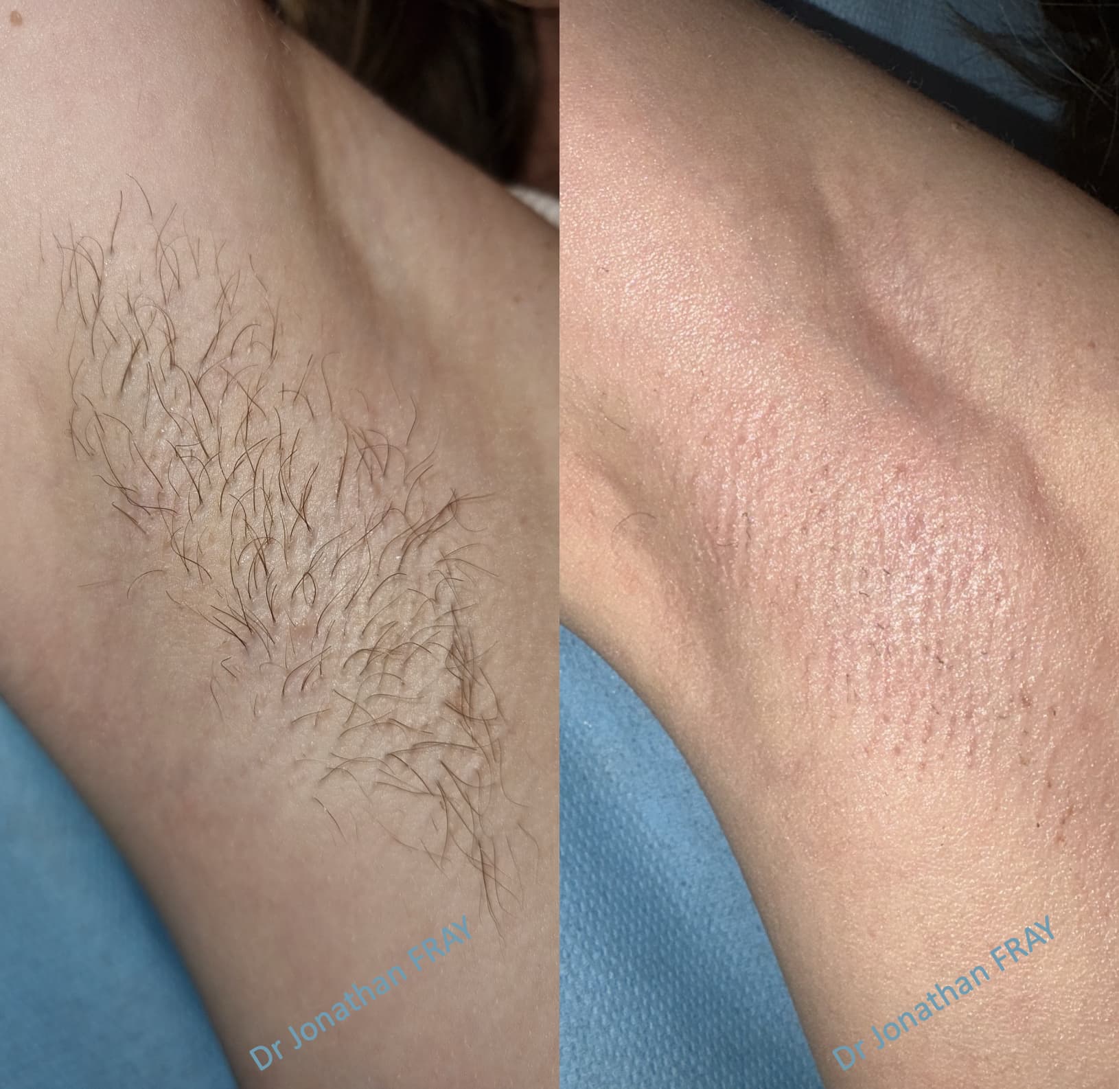 epilation-laser-aisselles-3