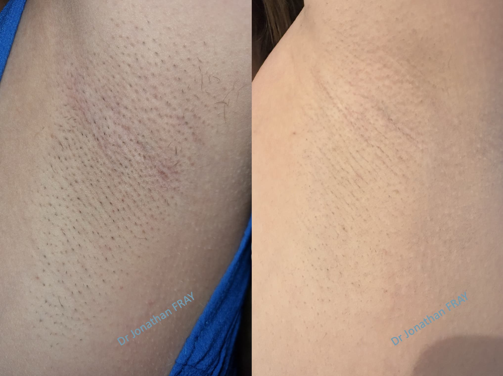 epilation-laser-aisselles-4