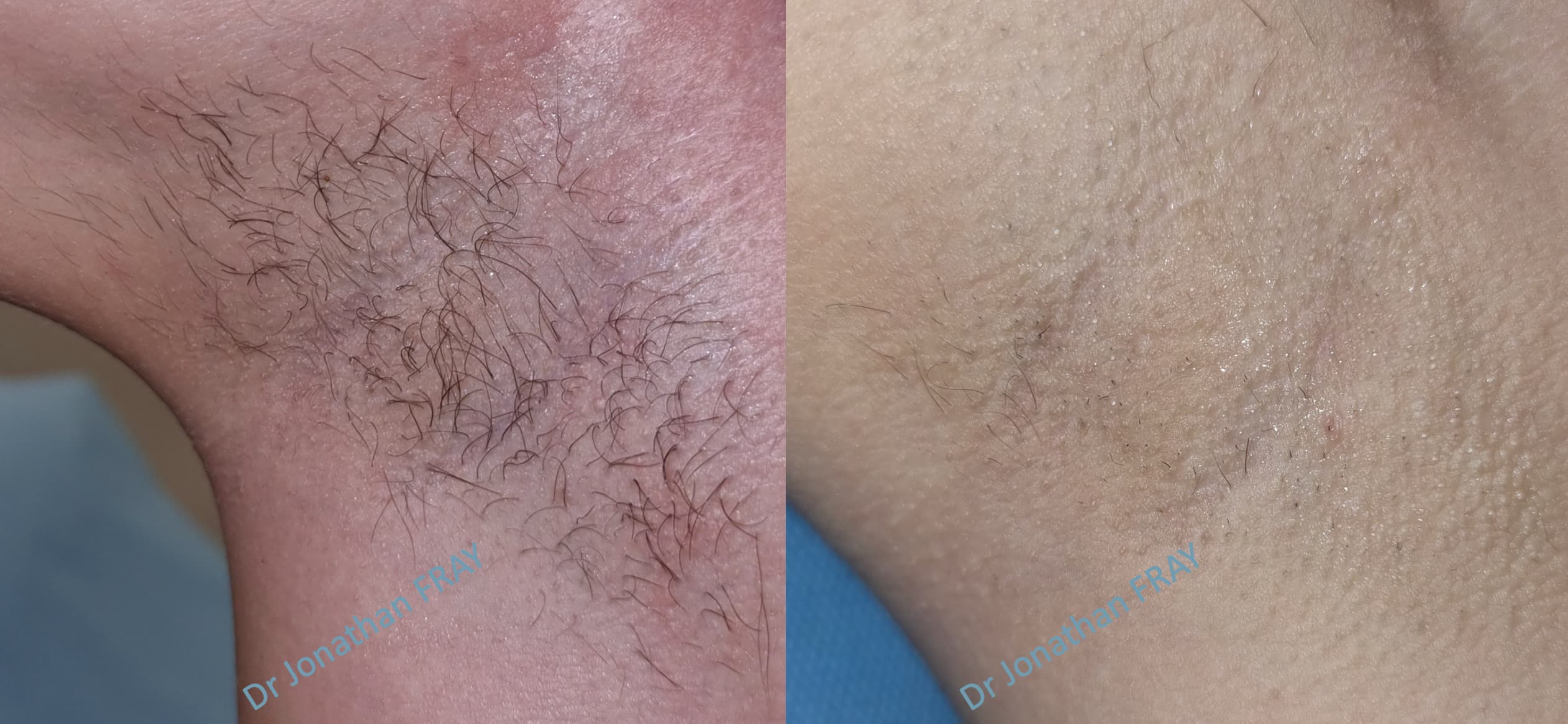epilation-laser-aisselles-5