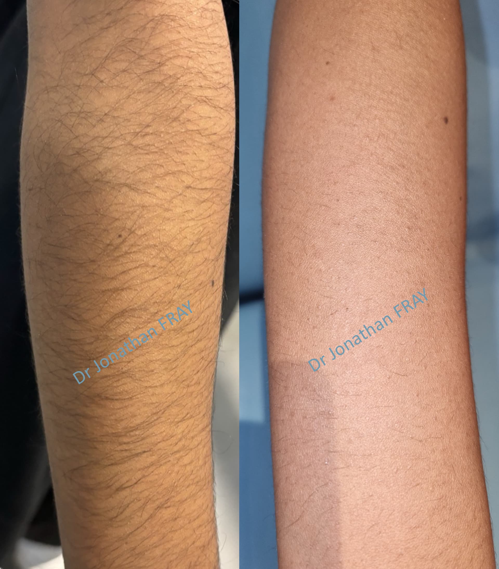 epilation-laser-bras-1