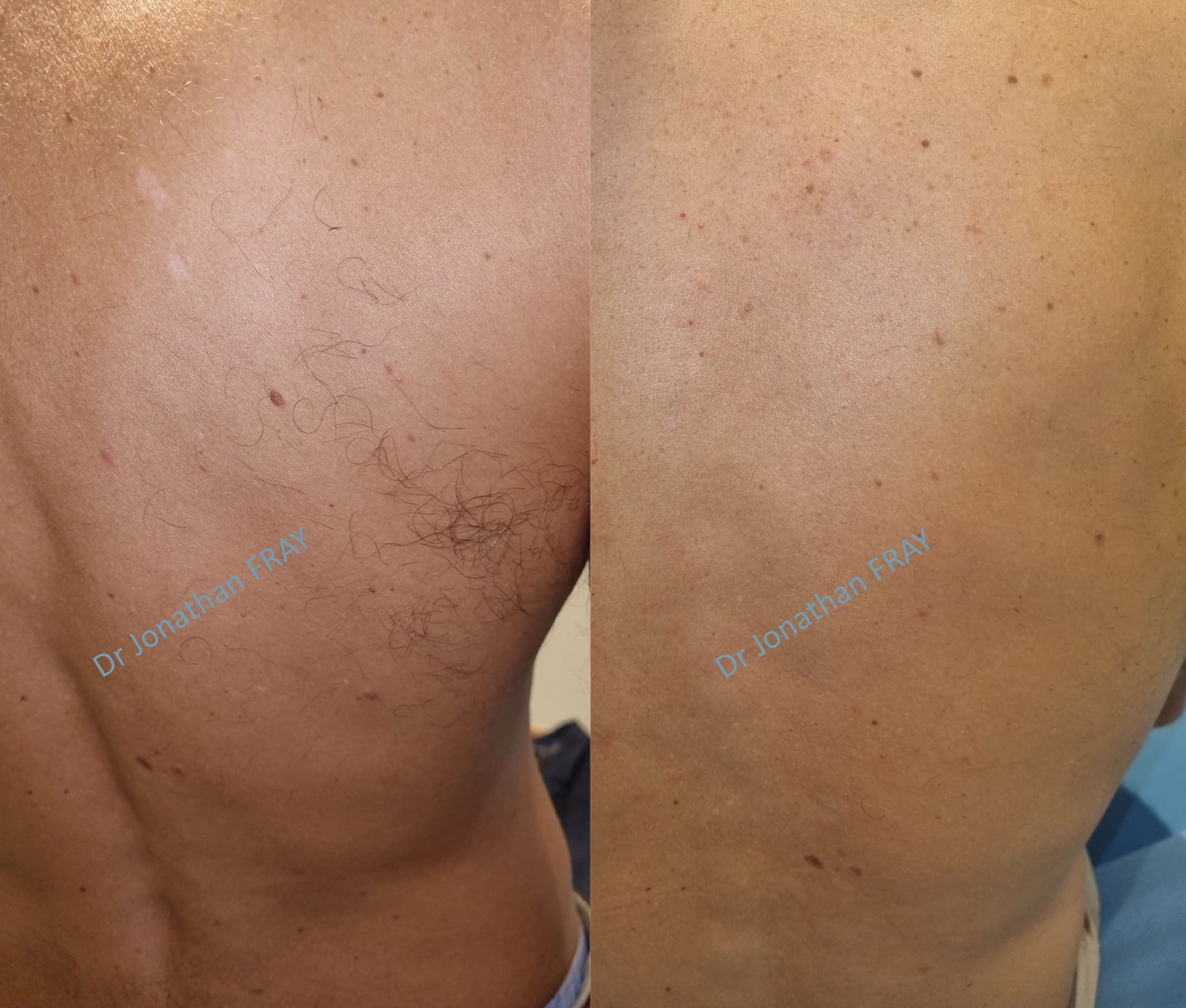 epilation-laser-dos-1