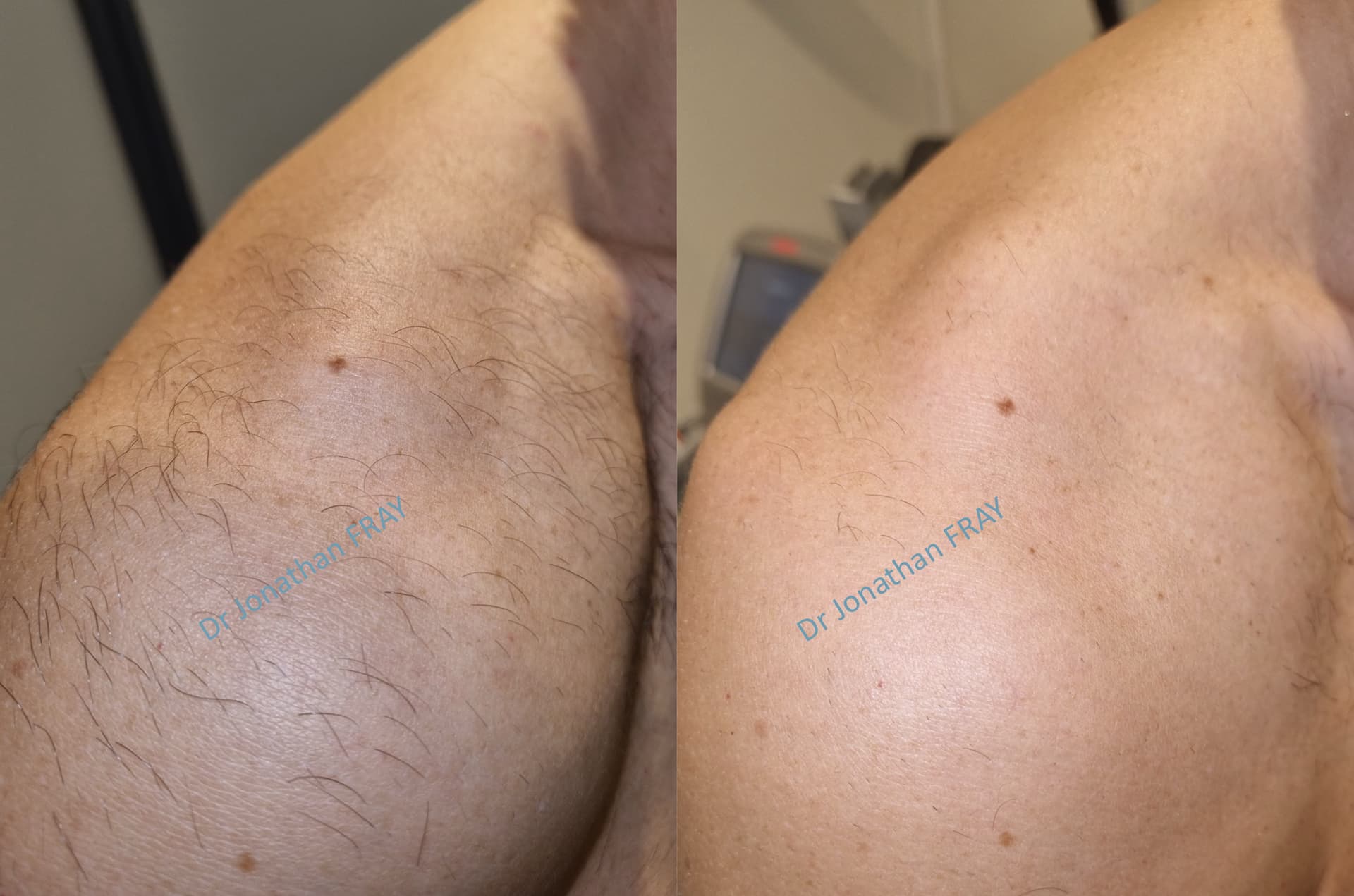 epilation-laser-epaules-1