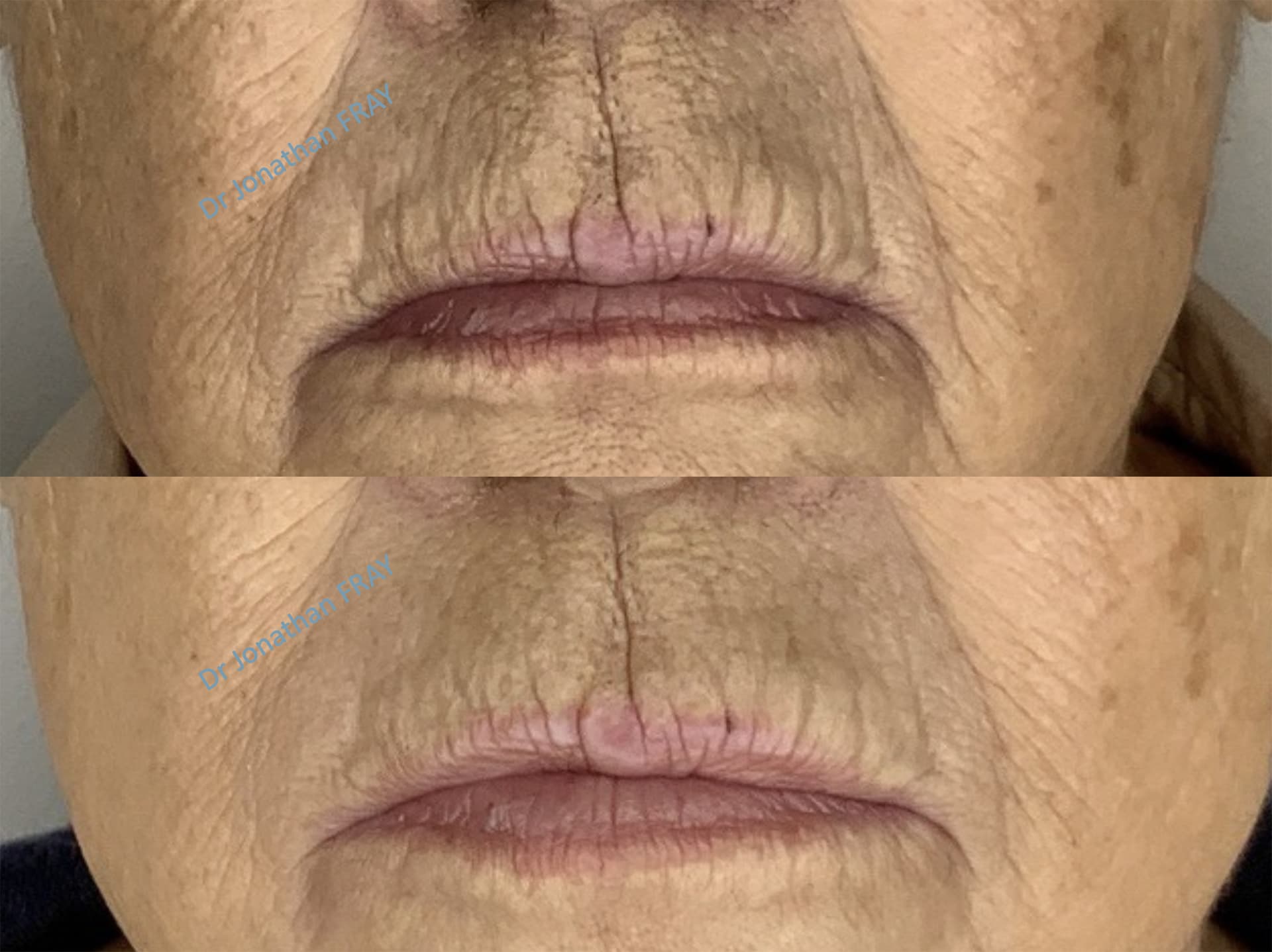 acide-hyaluronique-levres-2-avant-apres-1