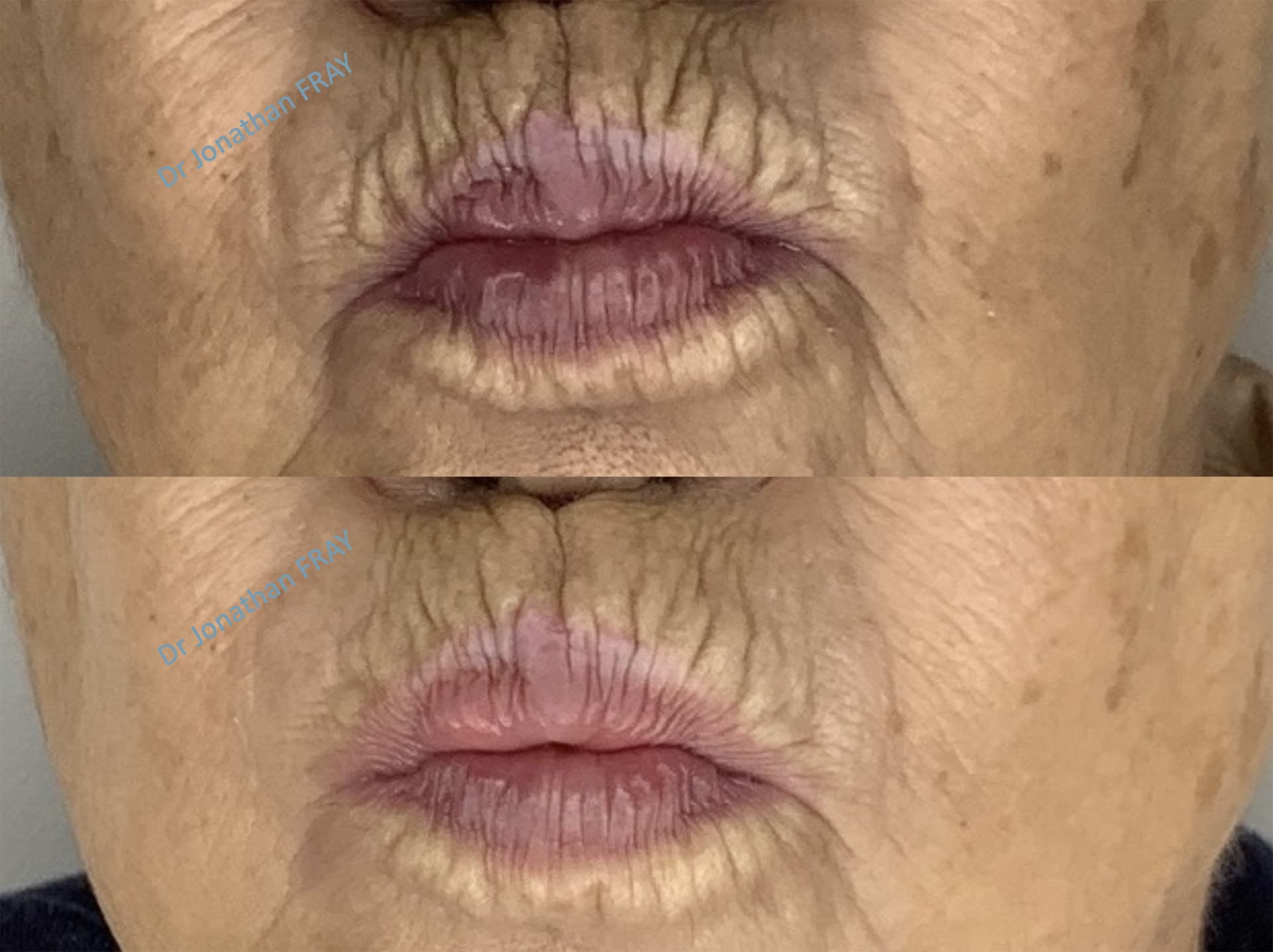 acide-hyaluronique-levres-2-avant-apres-2