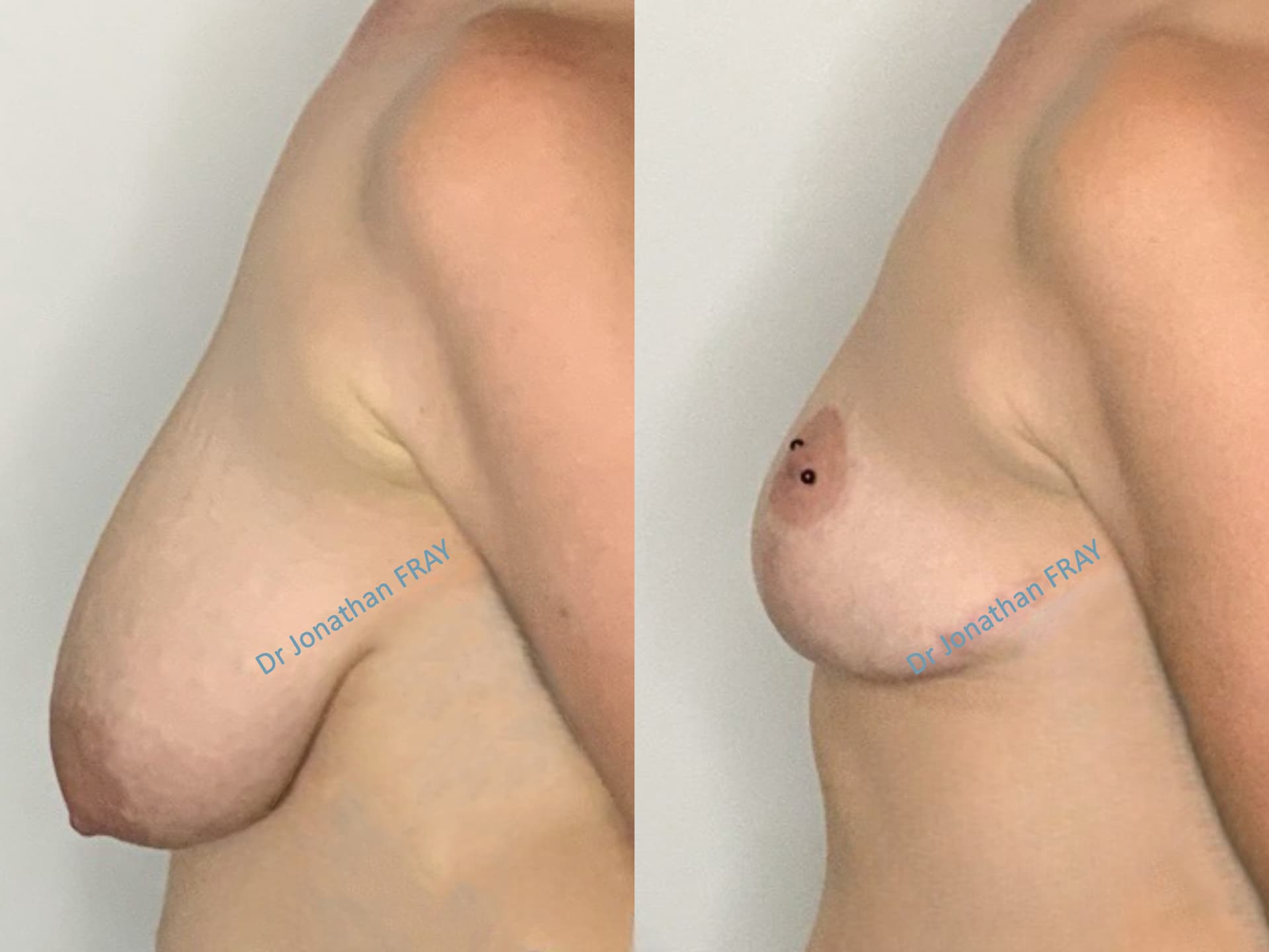 mastopexie-20-avant-apres-1