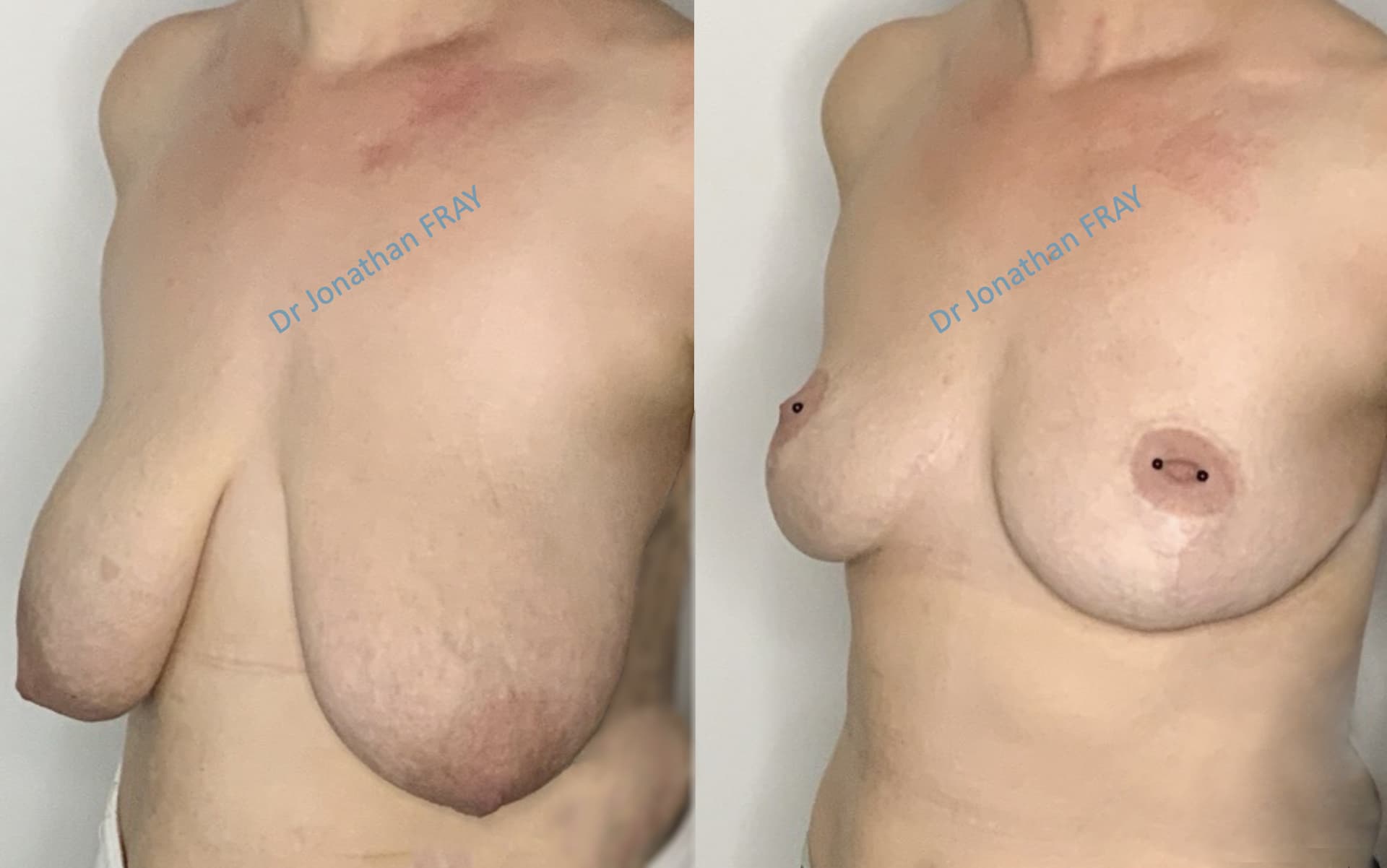 mastopexie-20-avant-apres-2