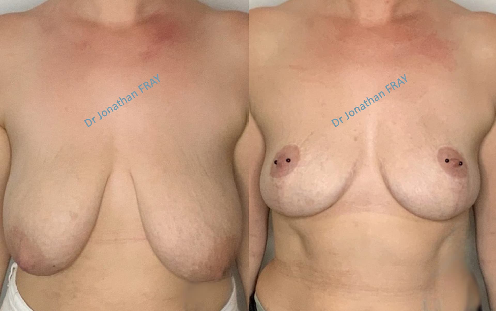 mastopexie-20-avant-apres-3