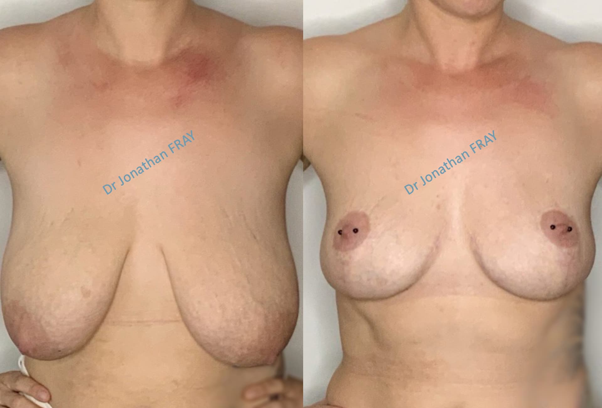 mastopexie-20-avant-apres-4