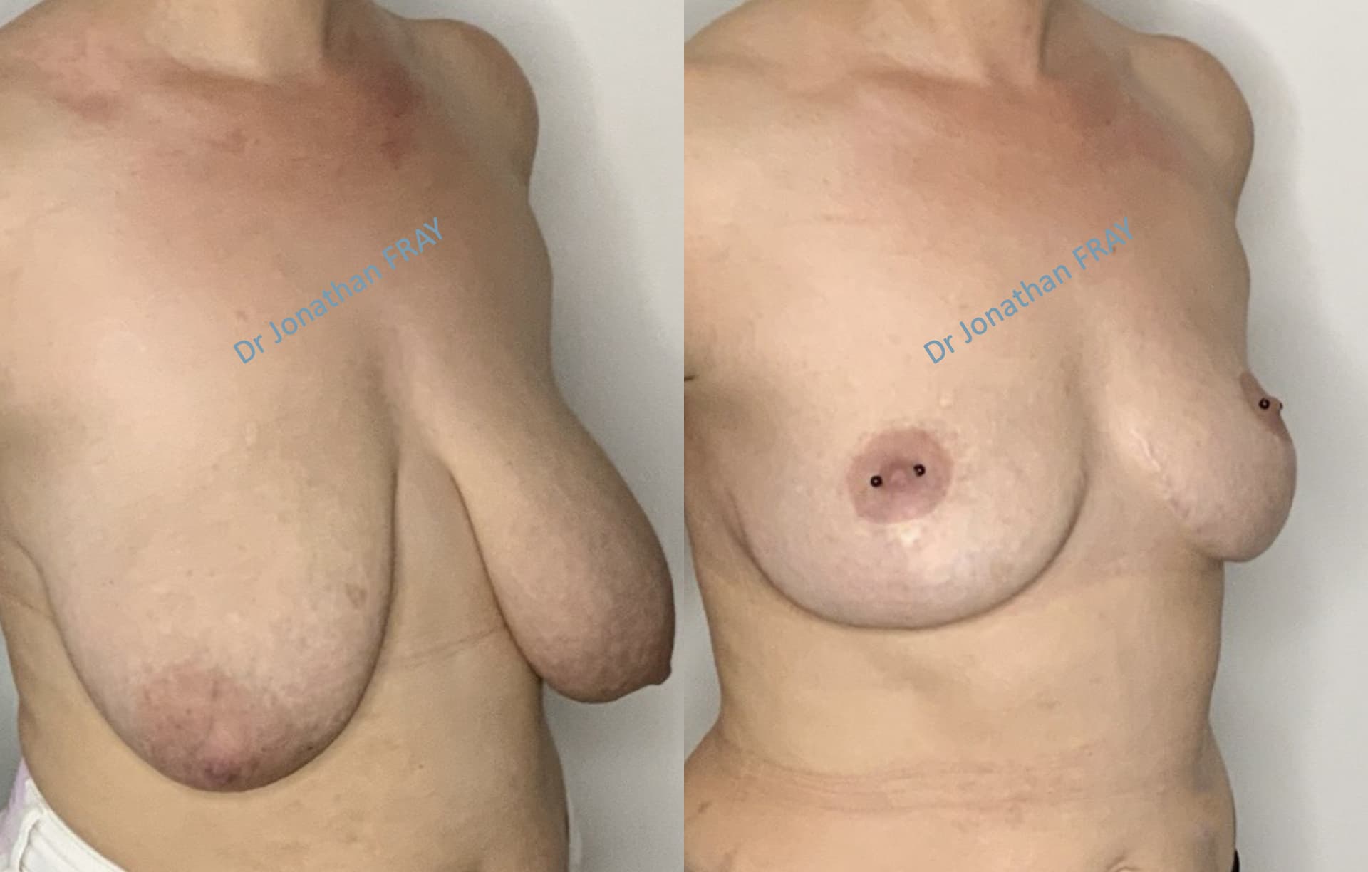 mastopexie-20-avant-apres-5