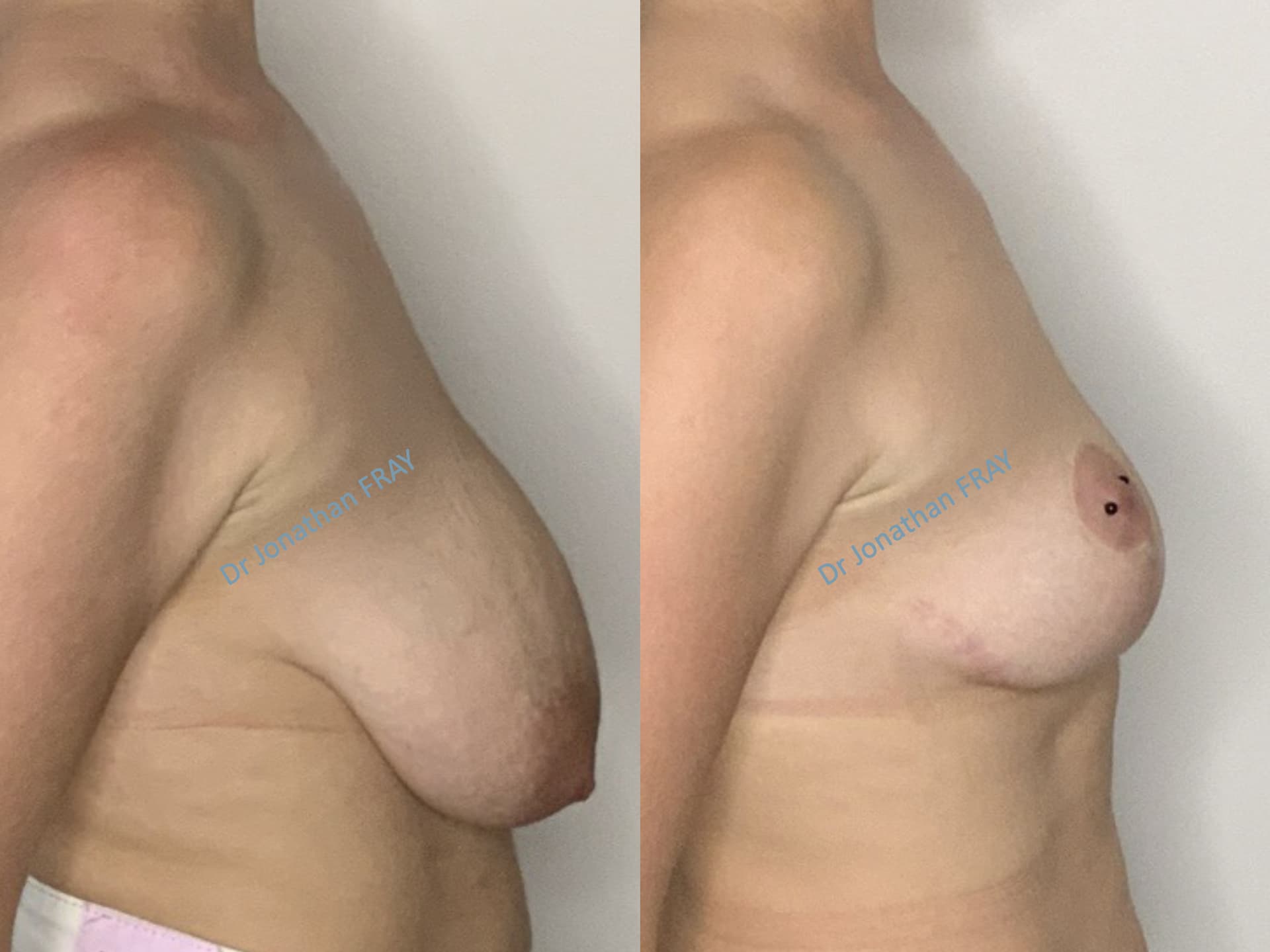 mastopexie-20-avant-apres-6