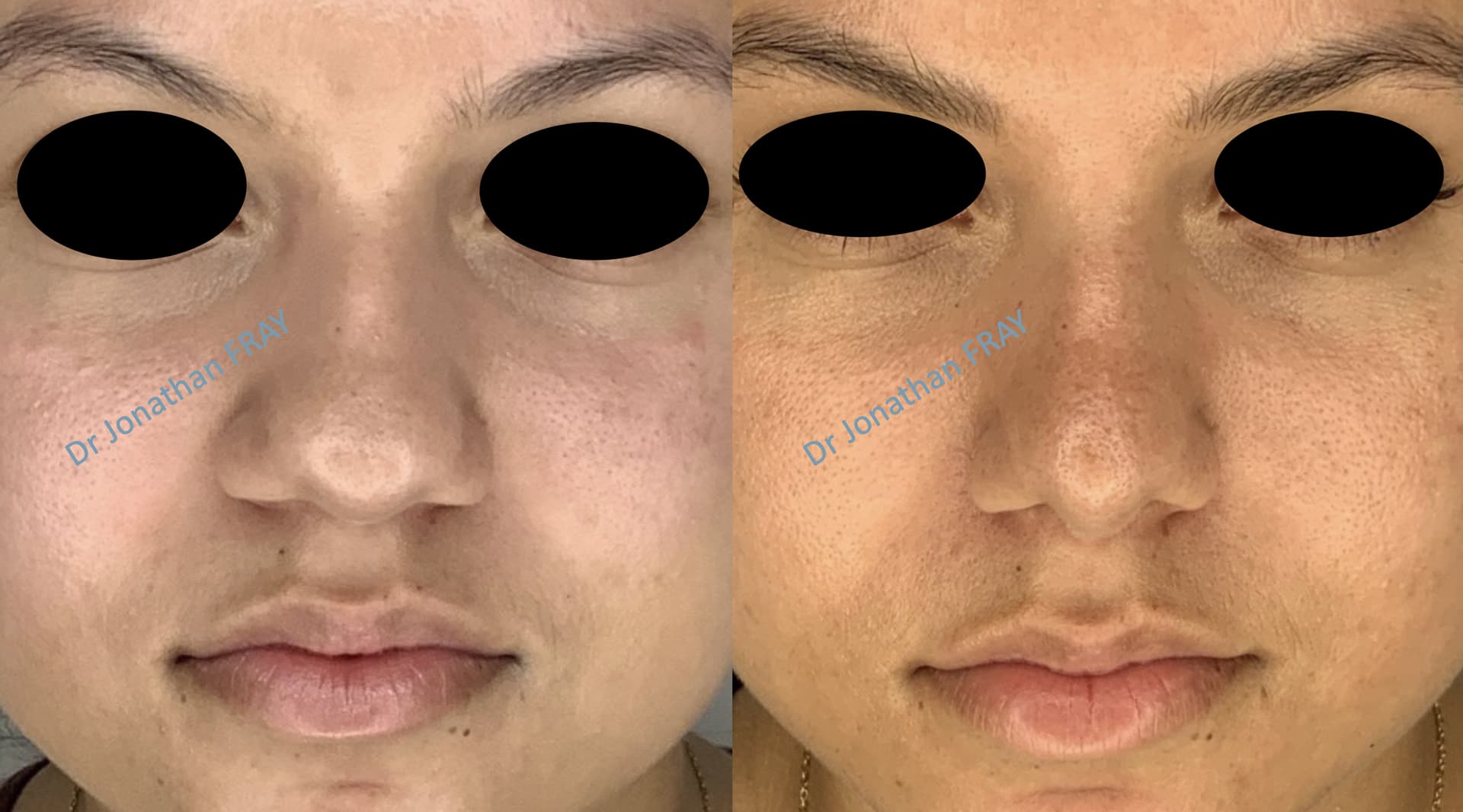 Résultat avant après d'une rhinoplastie vue de face