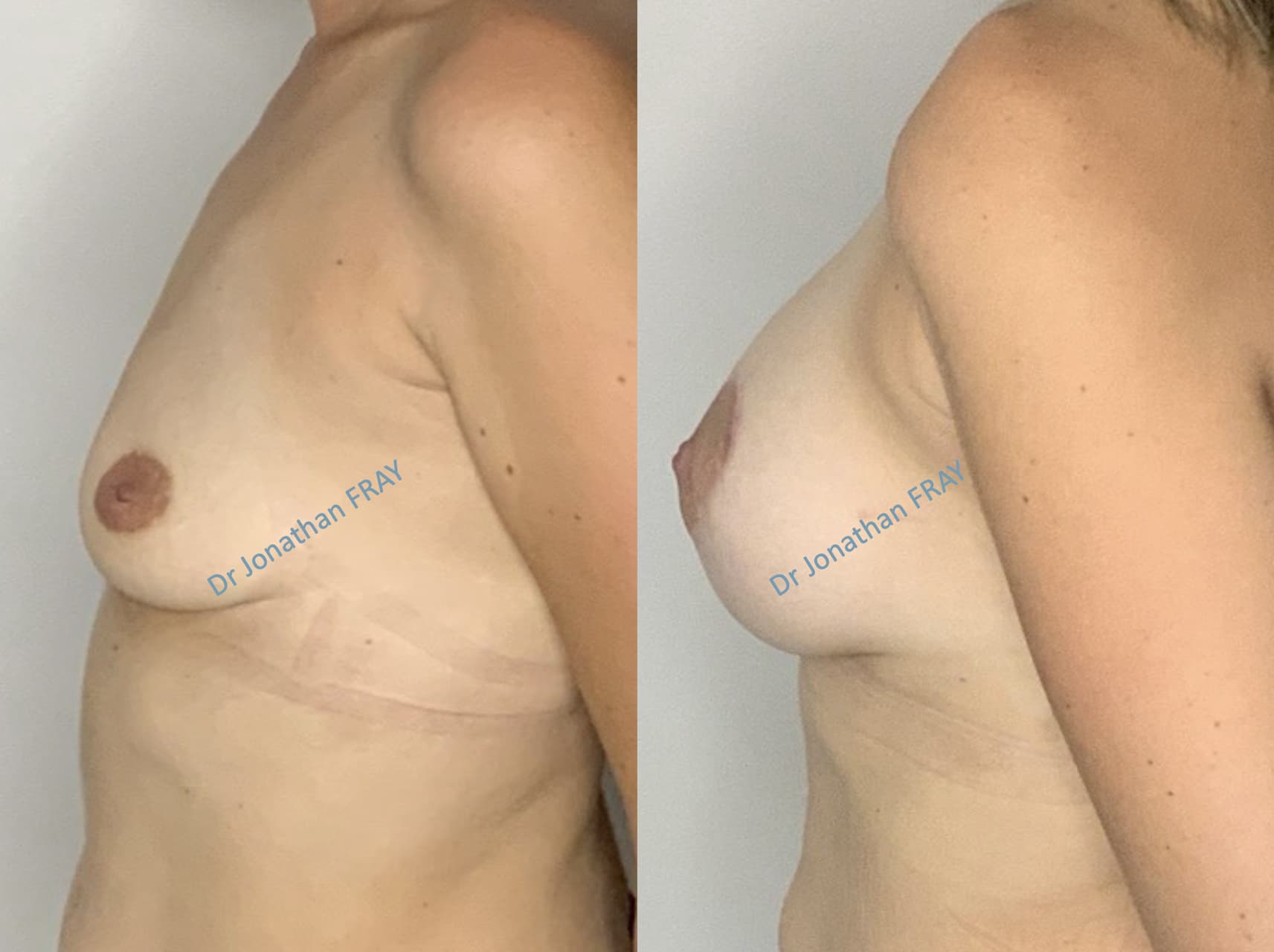 Exemple de résultat avant après de prothèses de seins - patiente 39 - vue 1