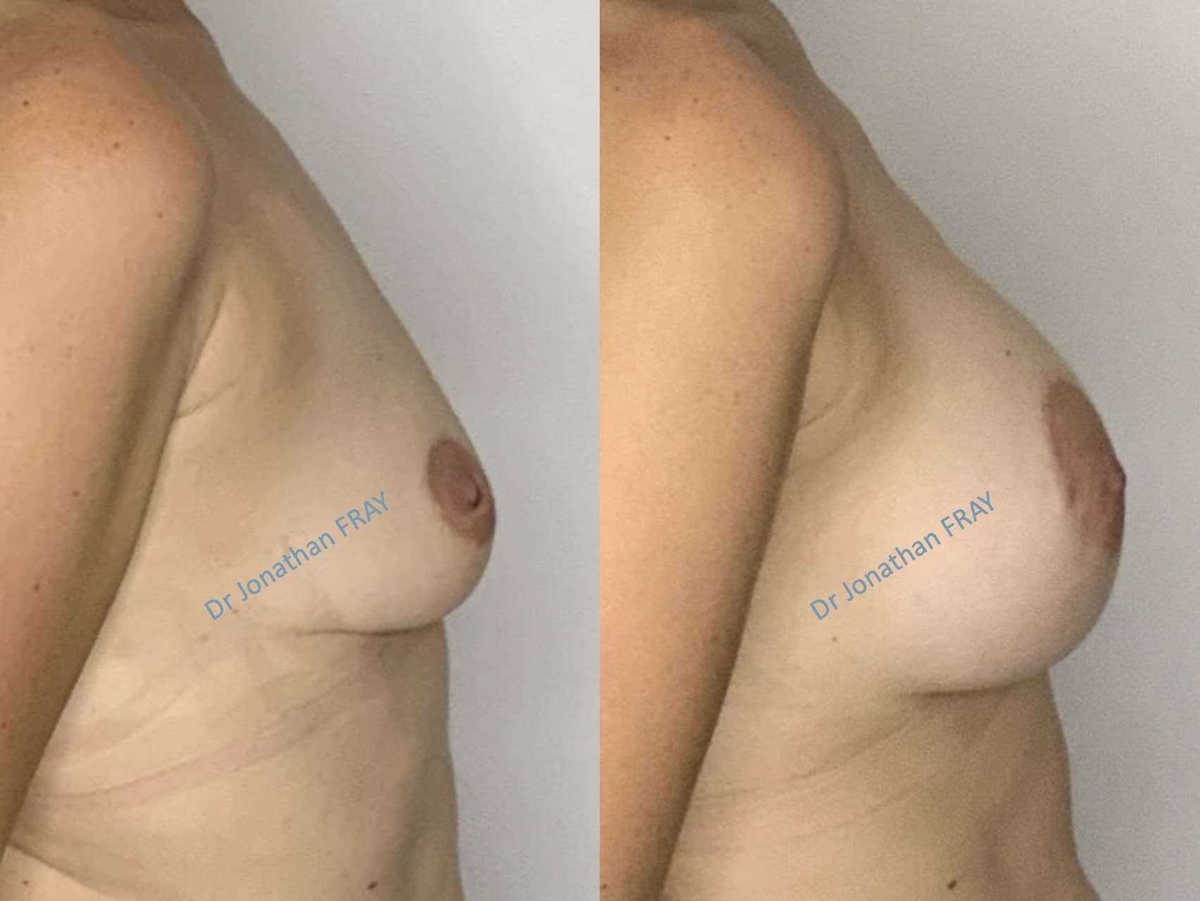 Exemple de résultat avant après de prothèses de seins - patiente 39 - vue 6