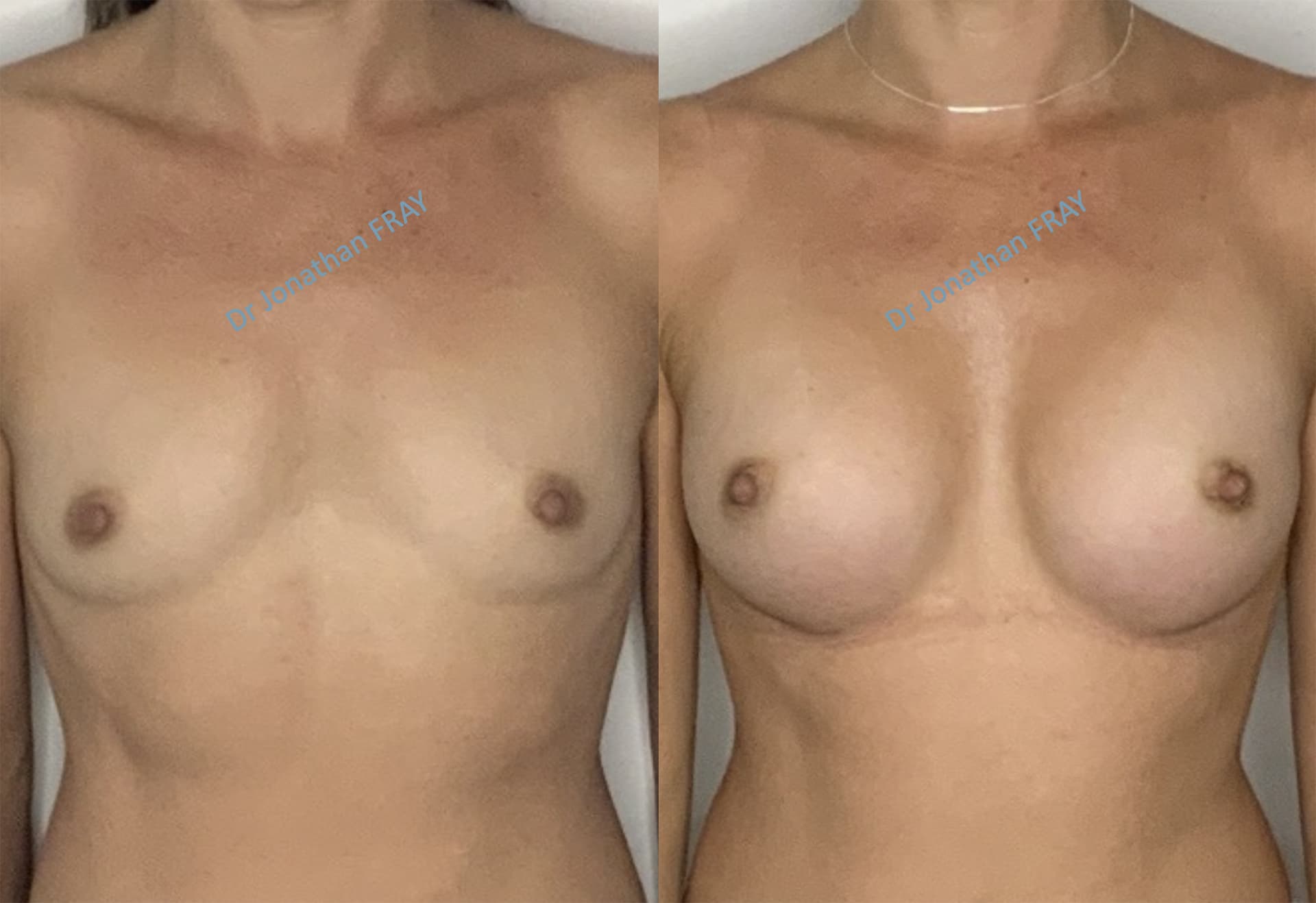 protheses-mammaires-41-avant-apres-3