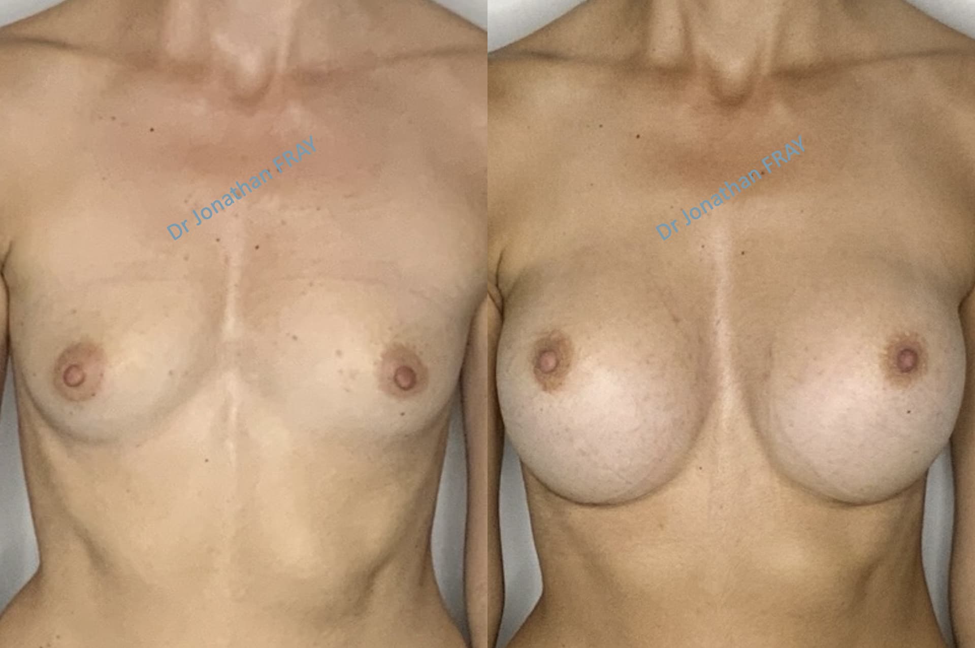 protheses-mammaires-42-avant-apres-3